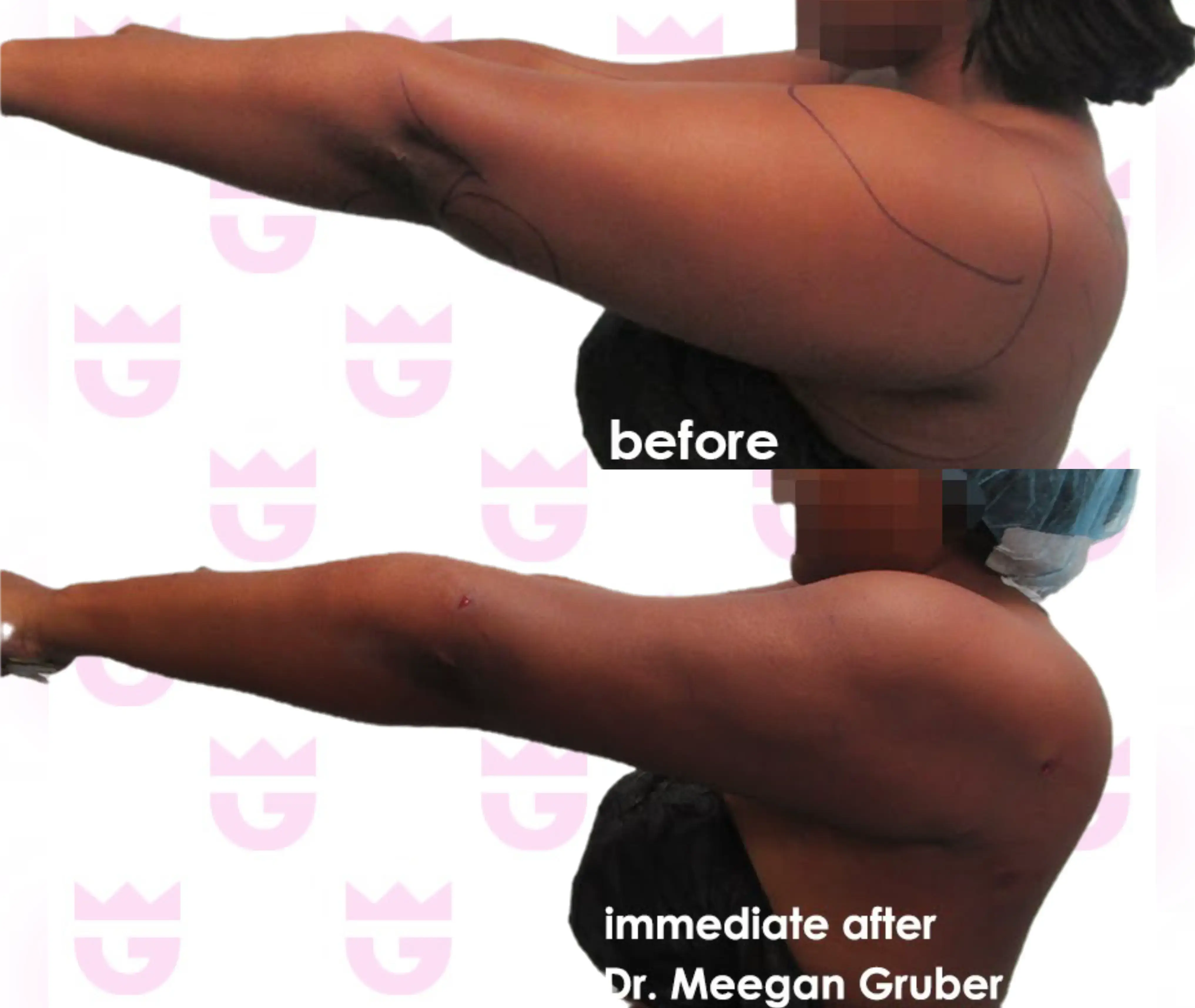 Arm Liposuction Gallery