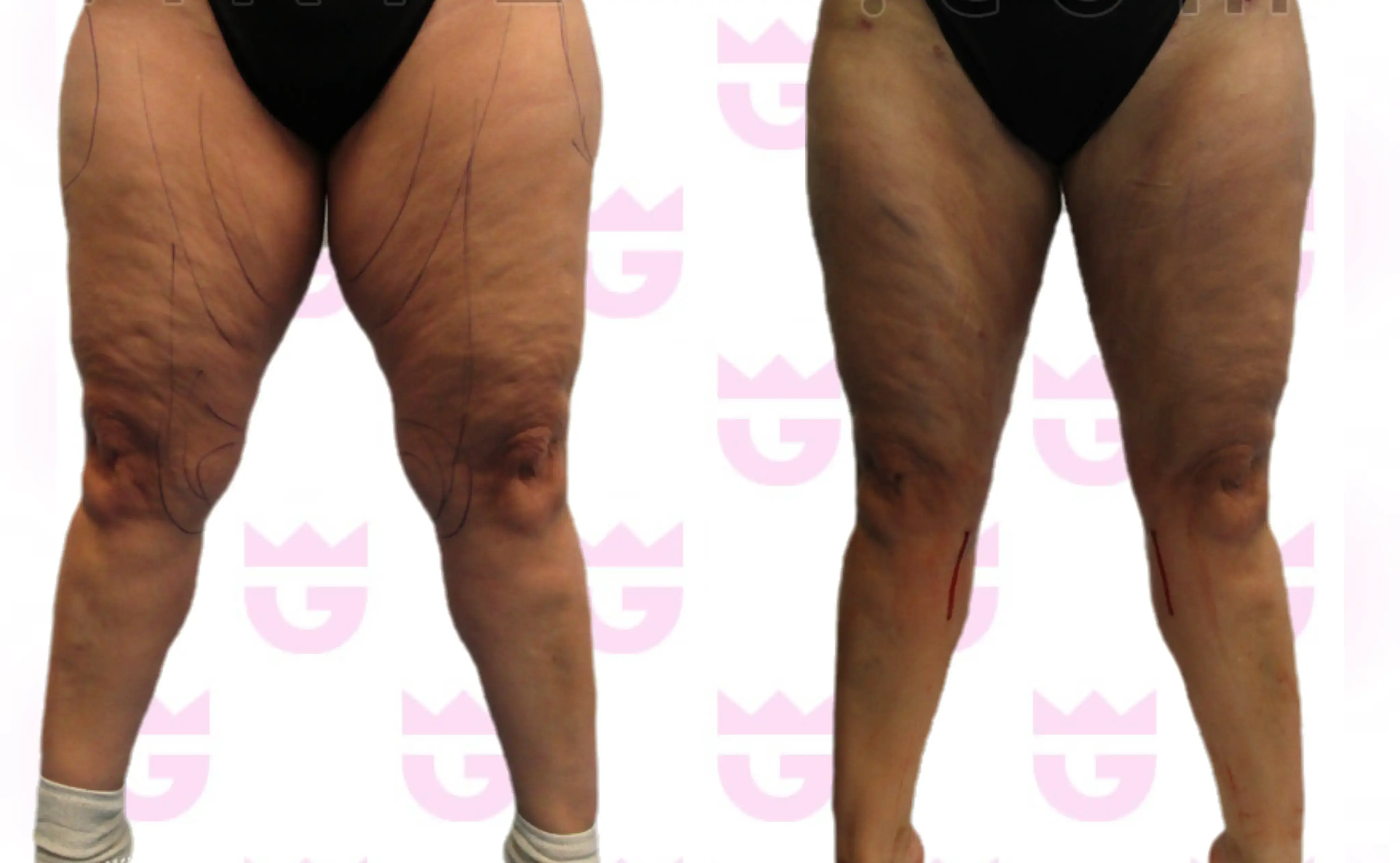 Knee Liposuction Gallery