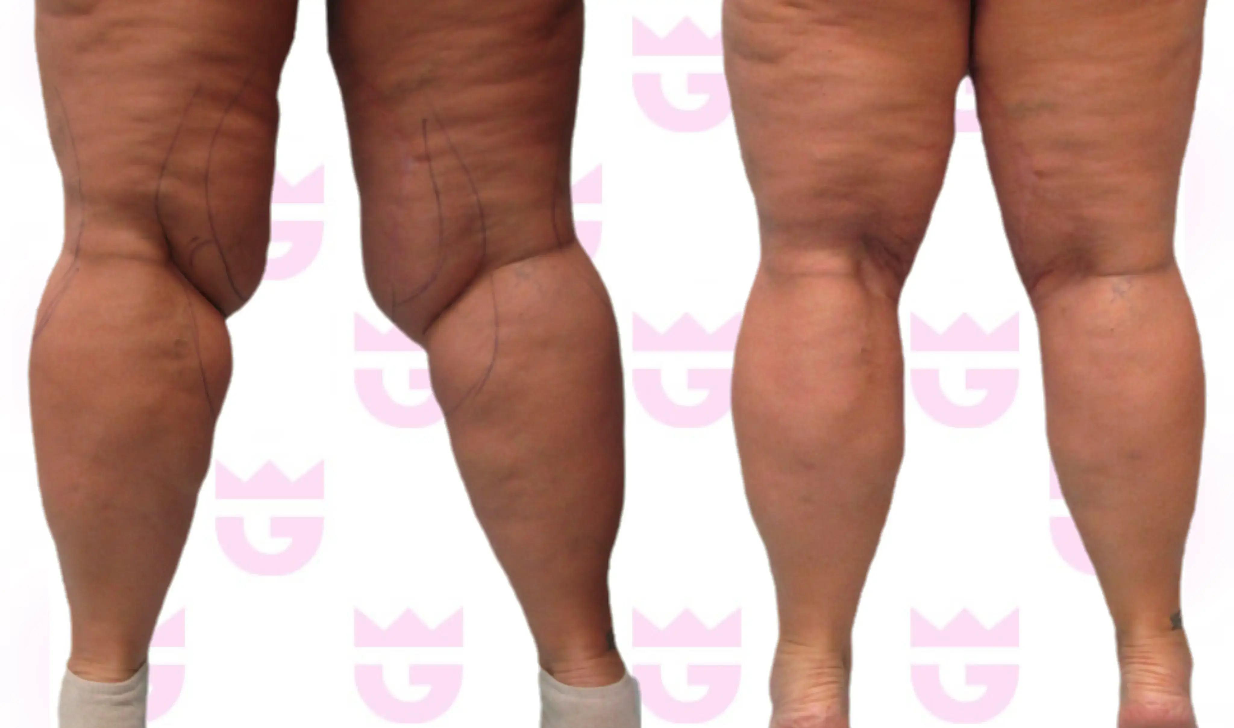 Knee Liposuction Gallery
