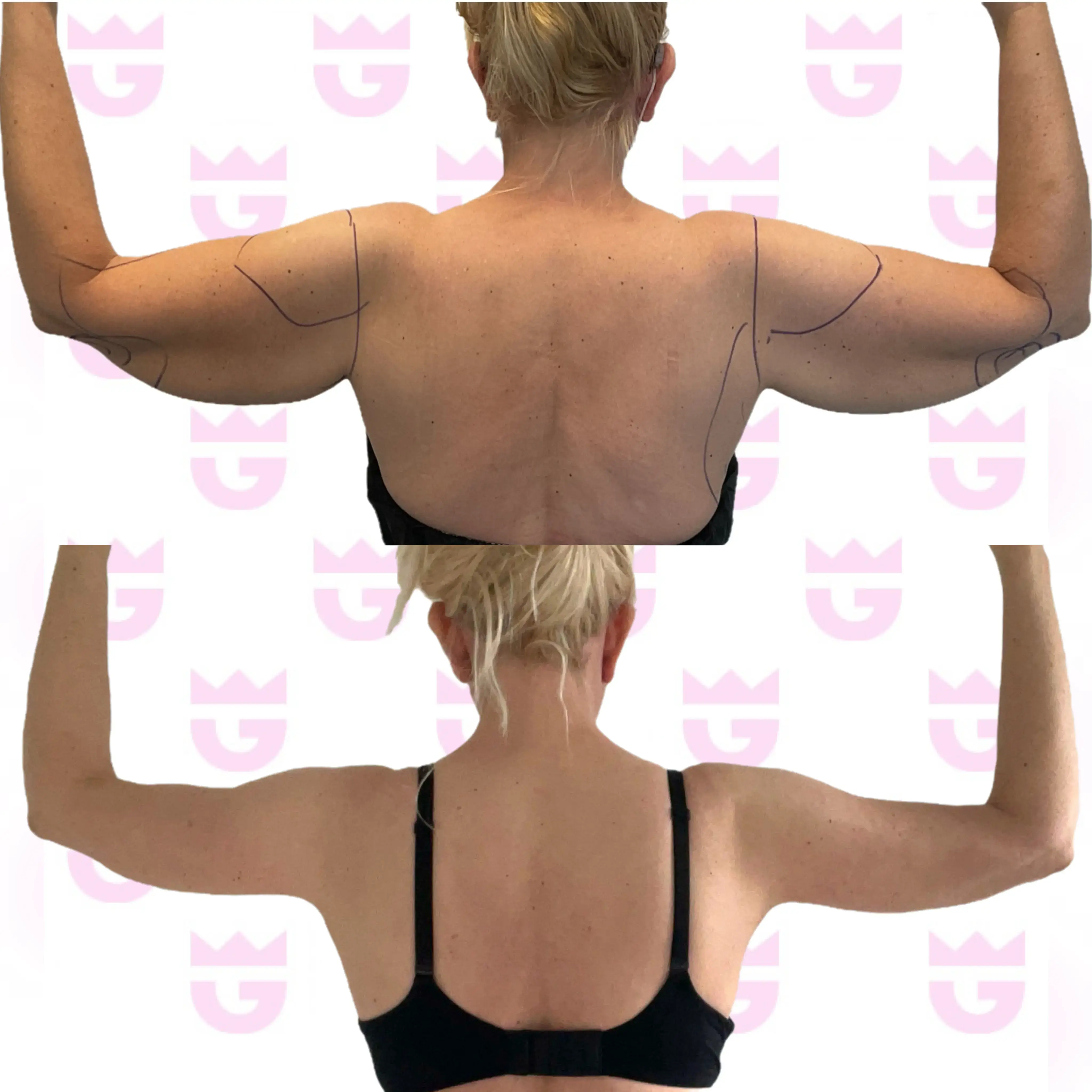 Arm Lift Gallery