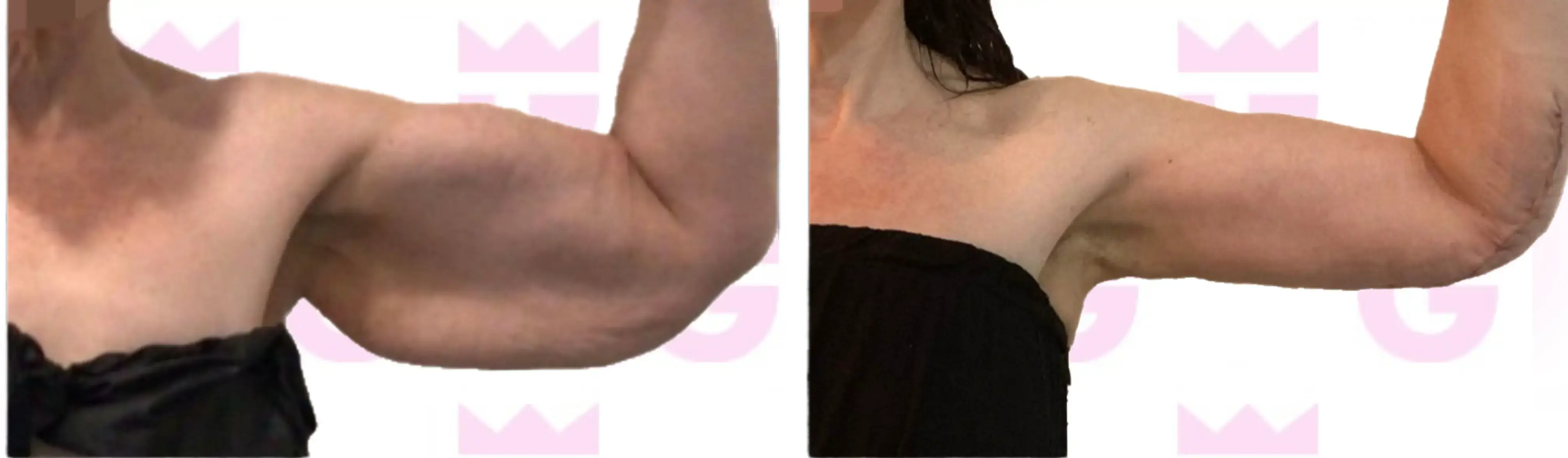 Arm Lift Gallery