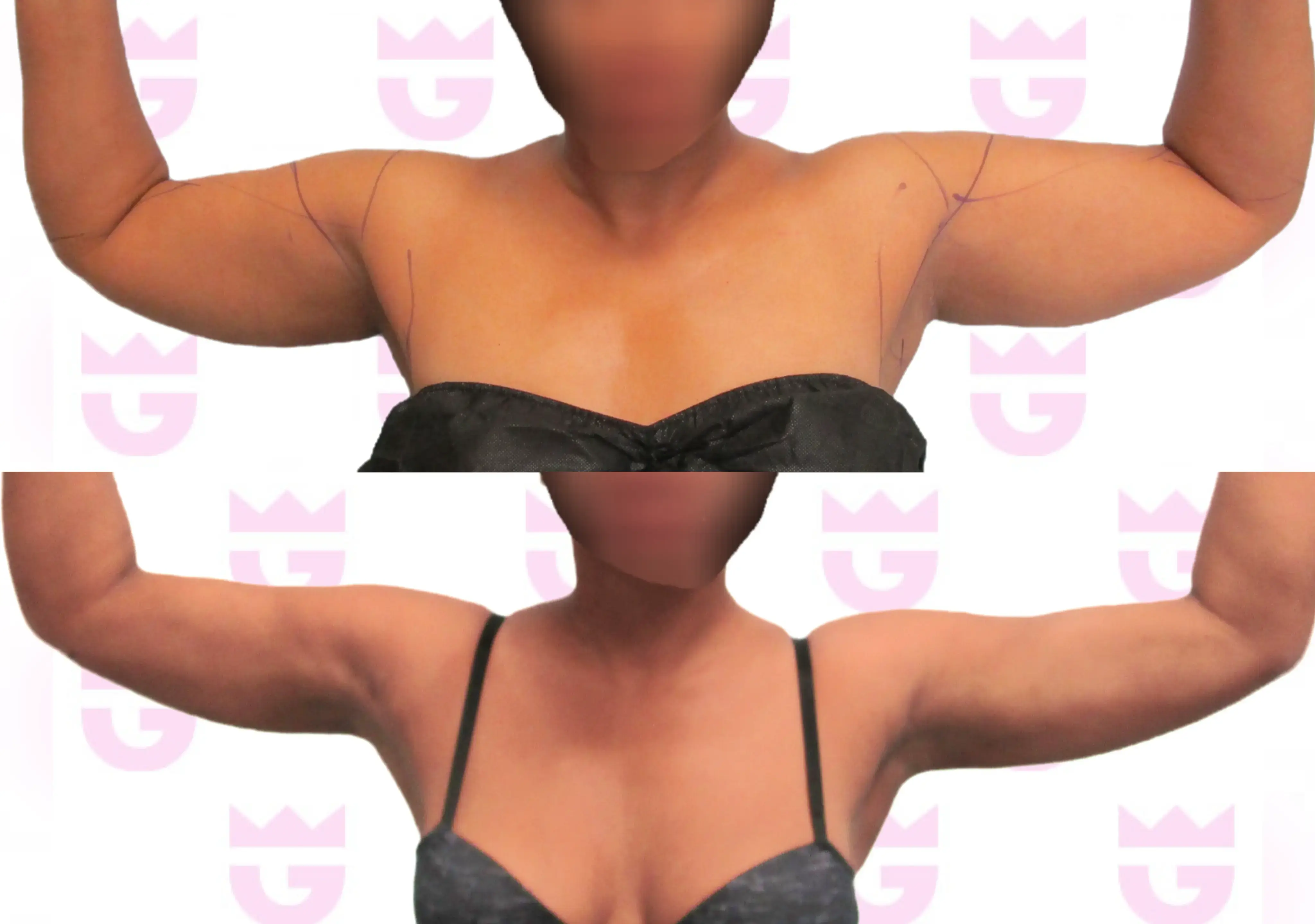 Armpit Liposuction Gallery