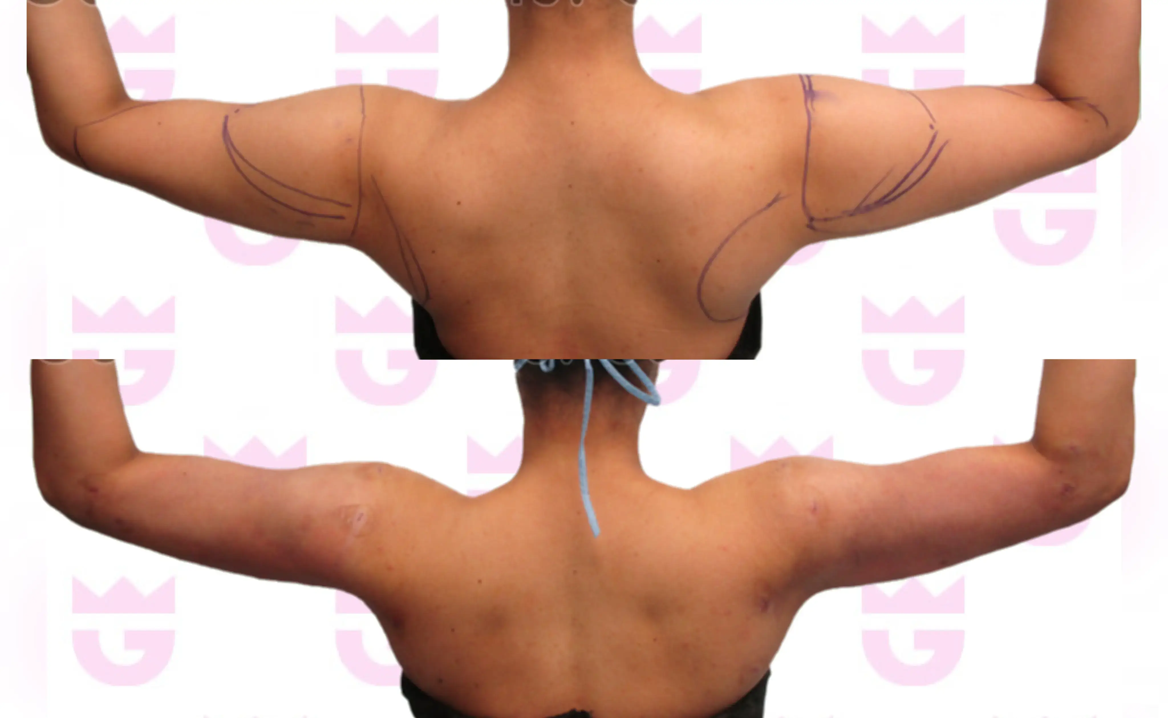 Arm Liposuction Gallery