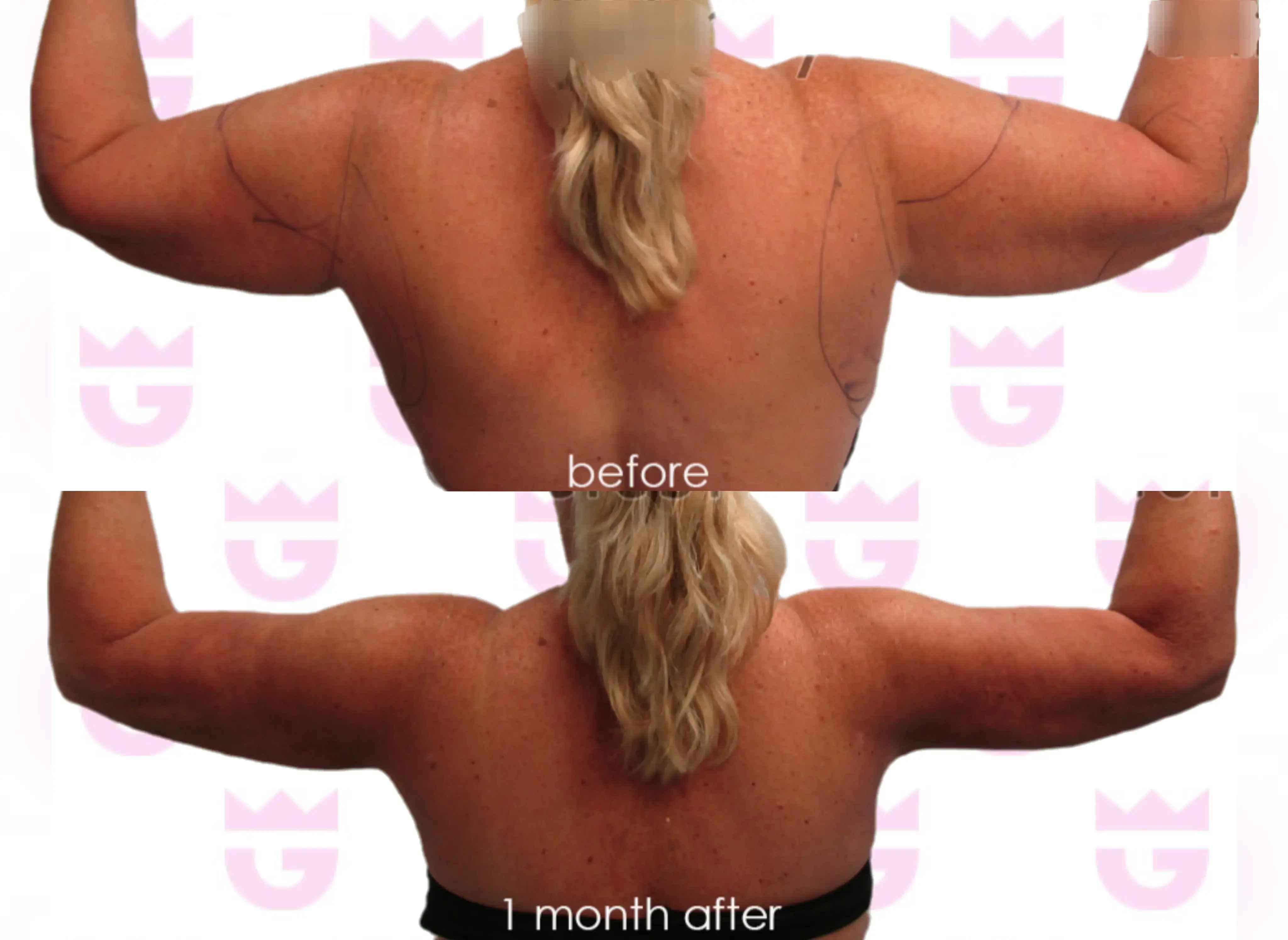 Armpit Liposuction Gallery