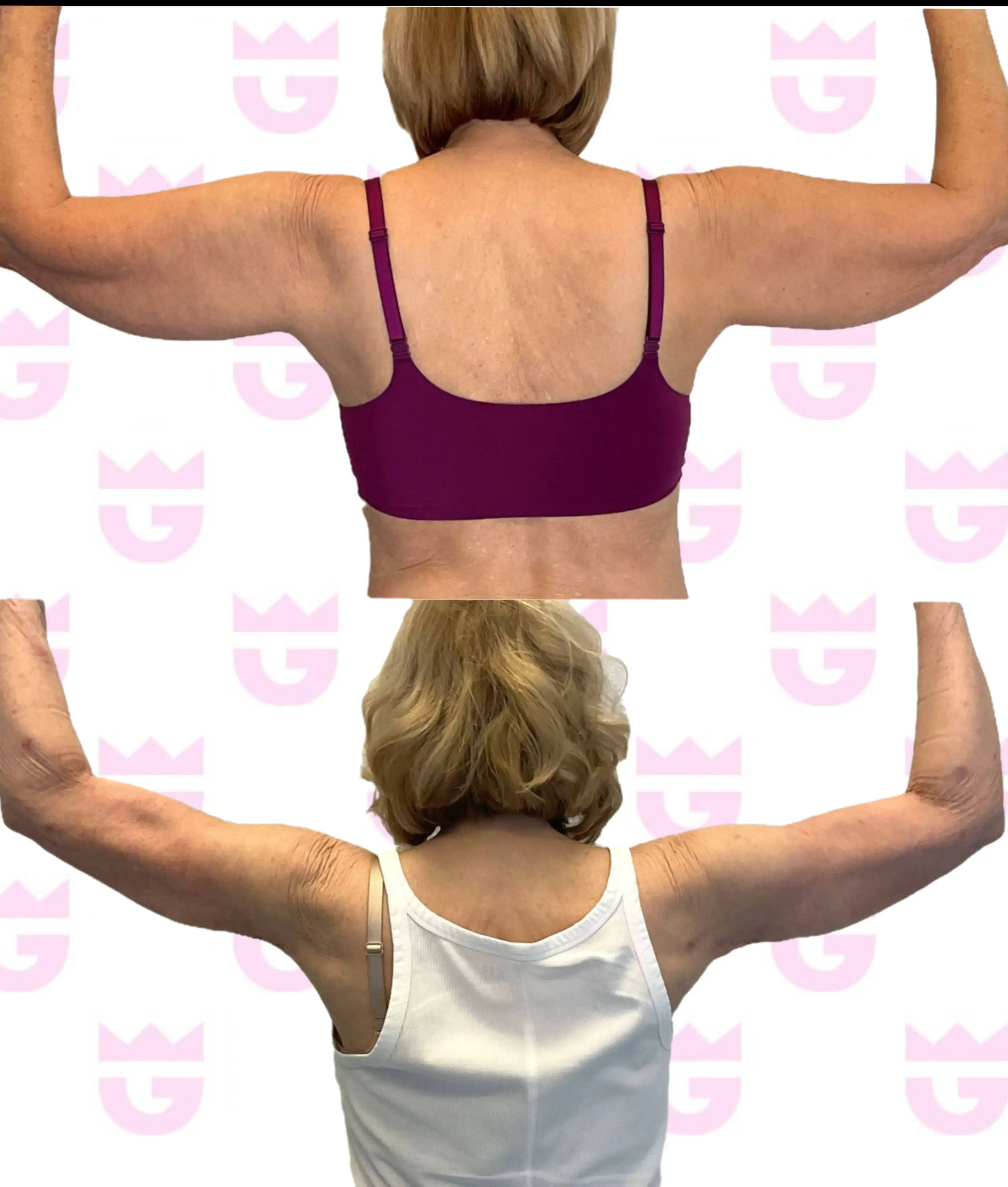 Mini Arm Lift Gallery