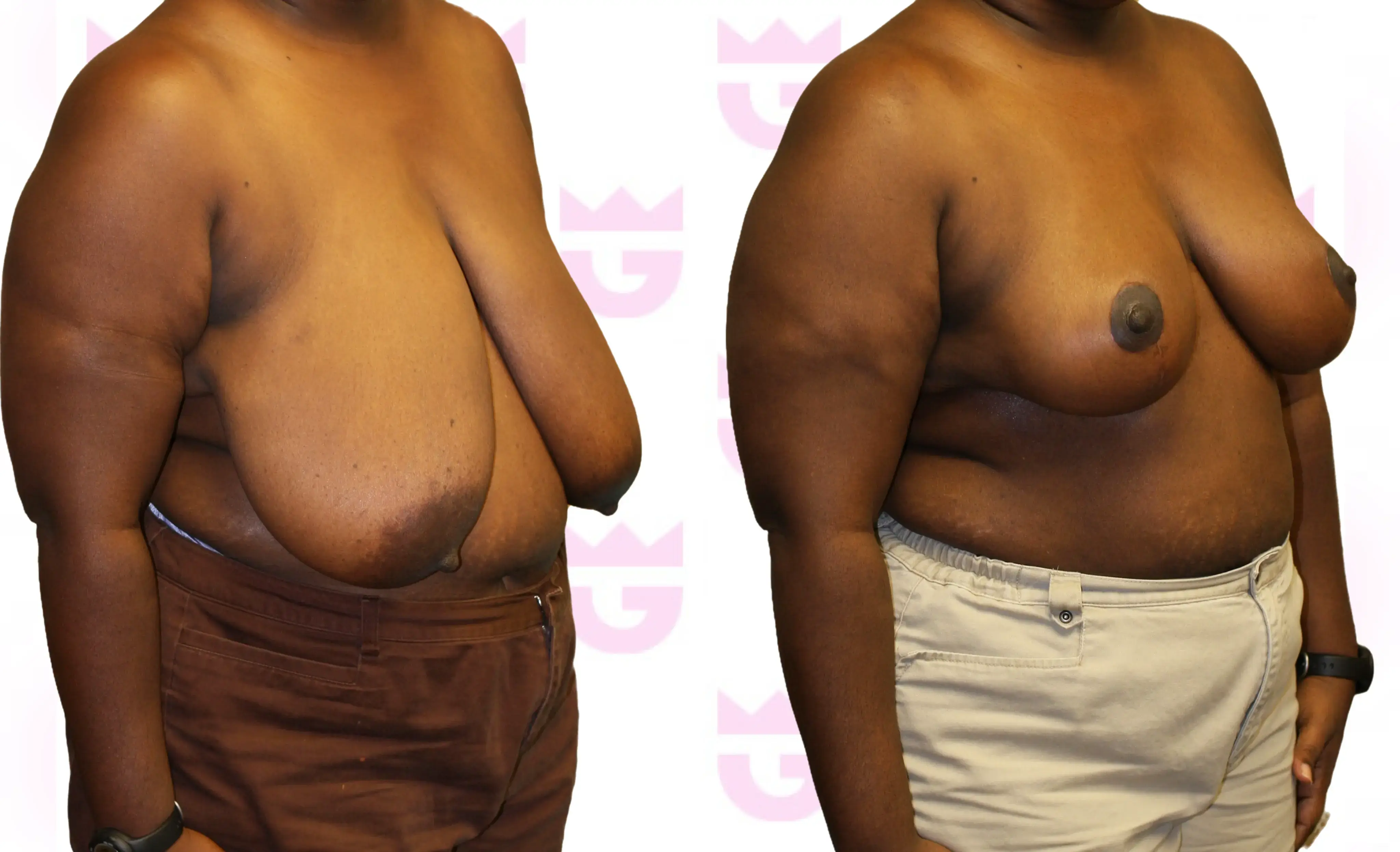 Breast Reduction Gallery