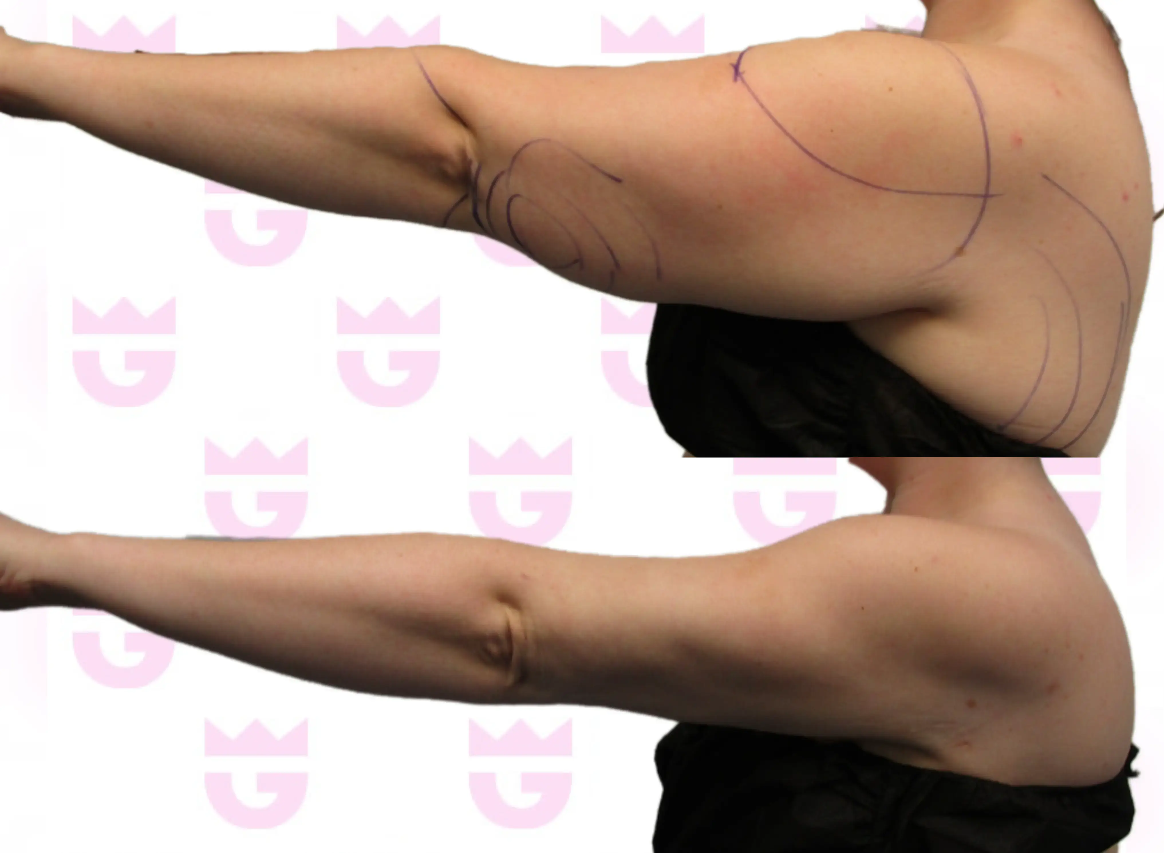 Arm Liposuction Gallery