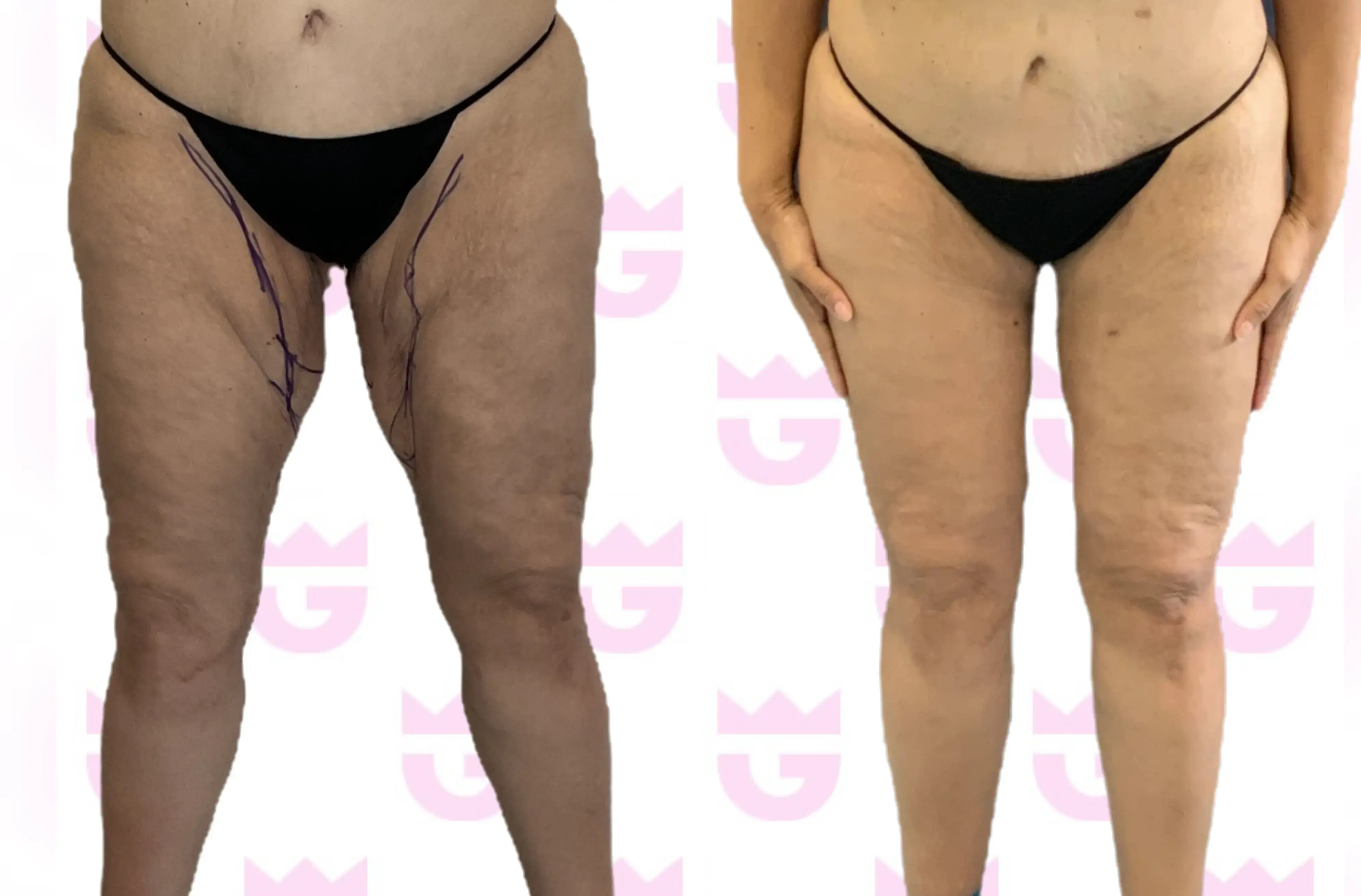 Thigh Lift Gallery