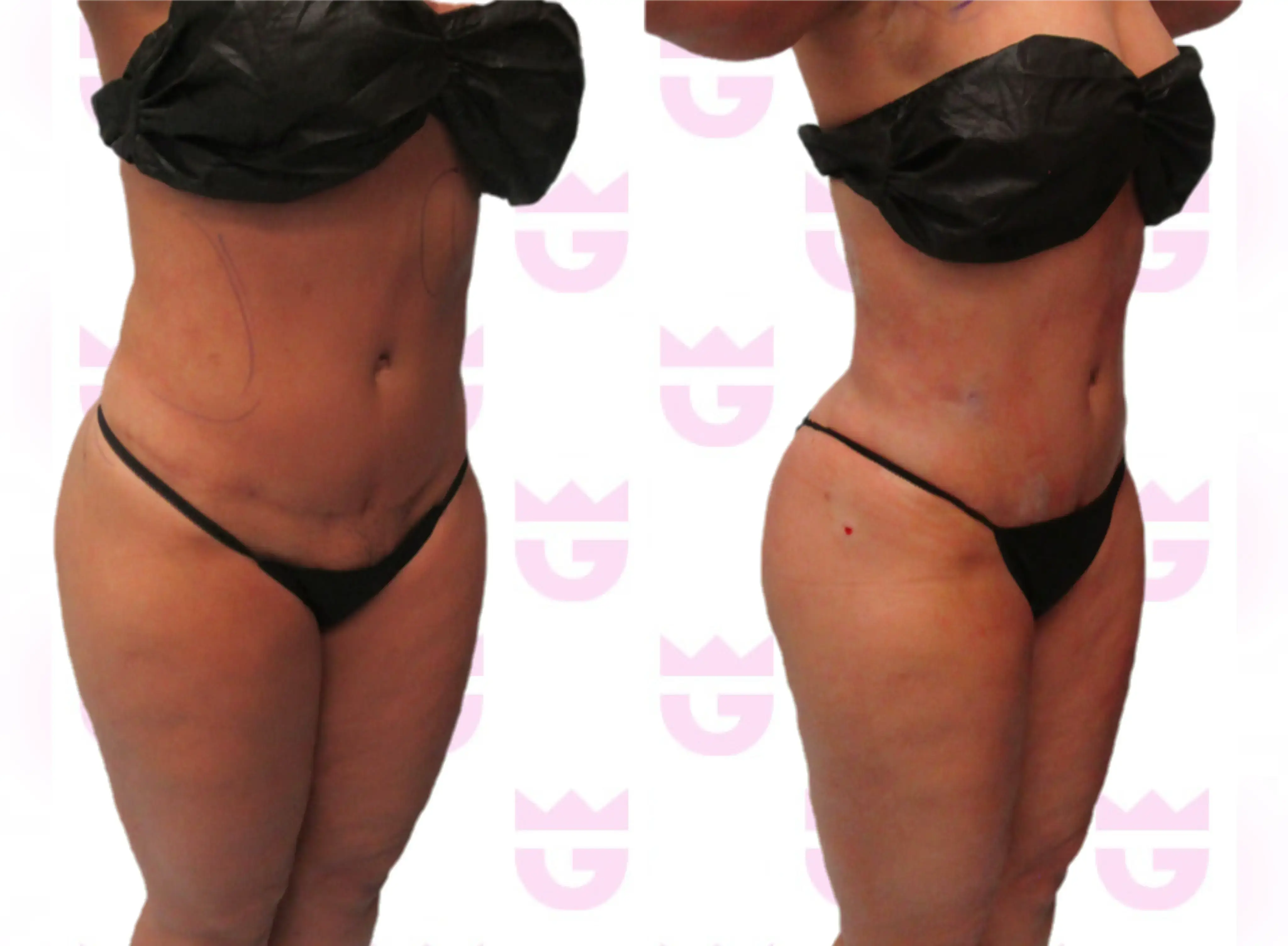 Abdomen Liposuction Gallery