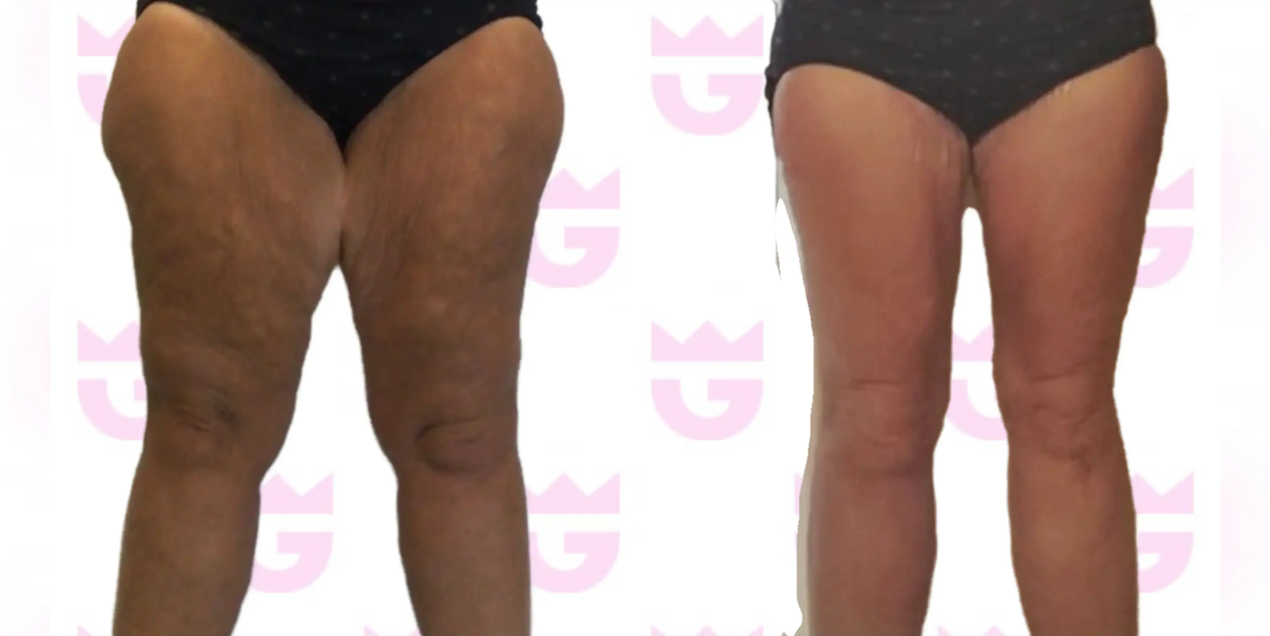 Thigh Lift Gallery