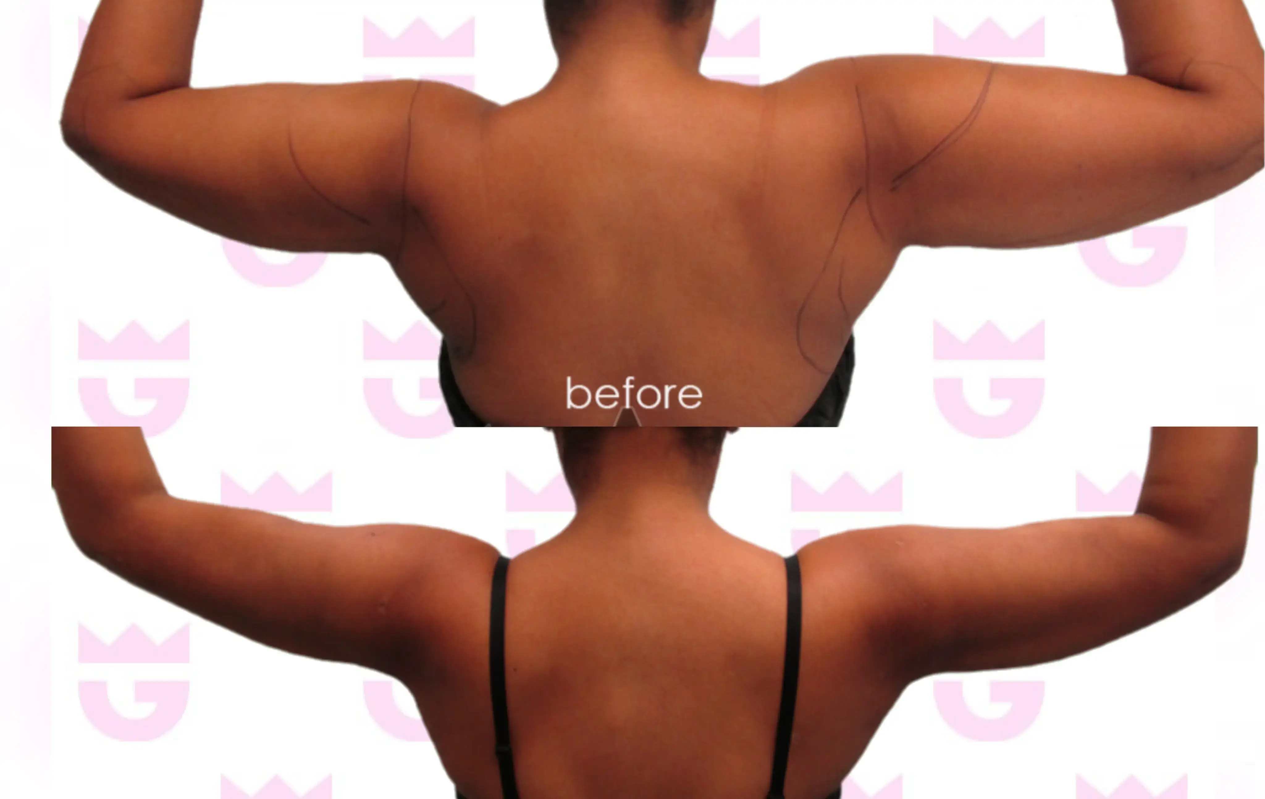 Arm Liposuction Gallery