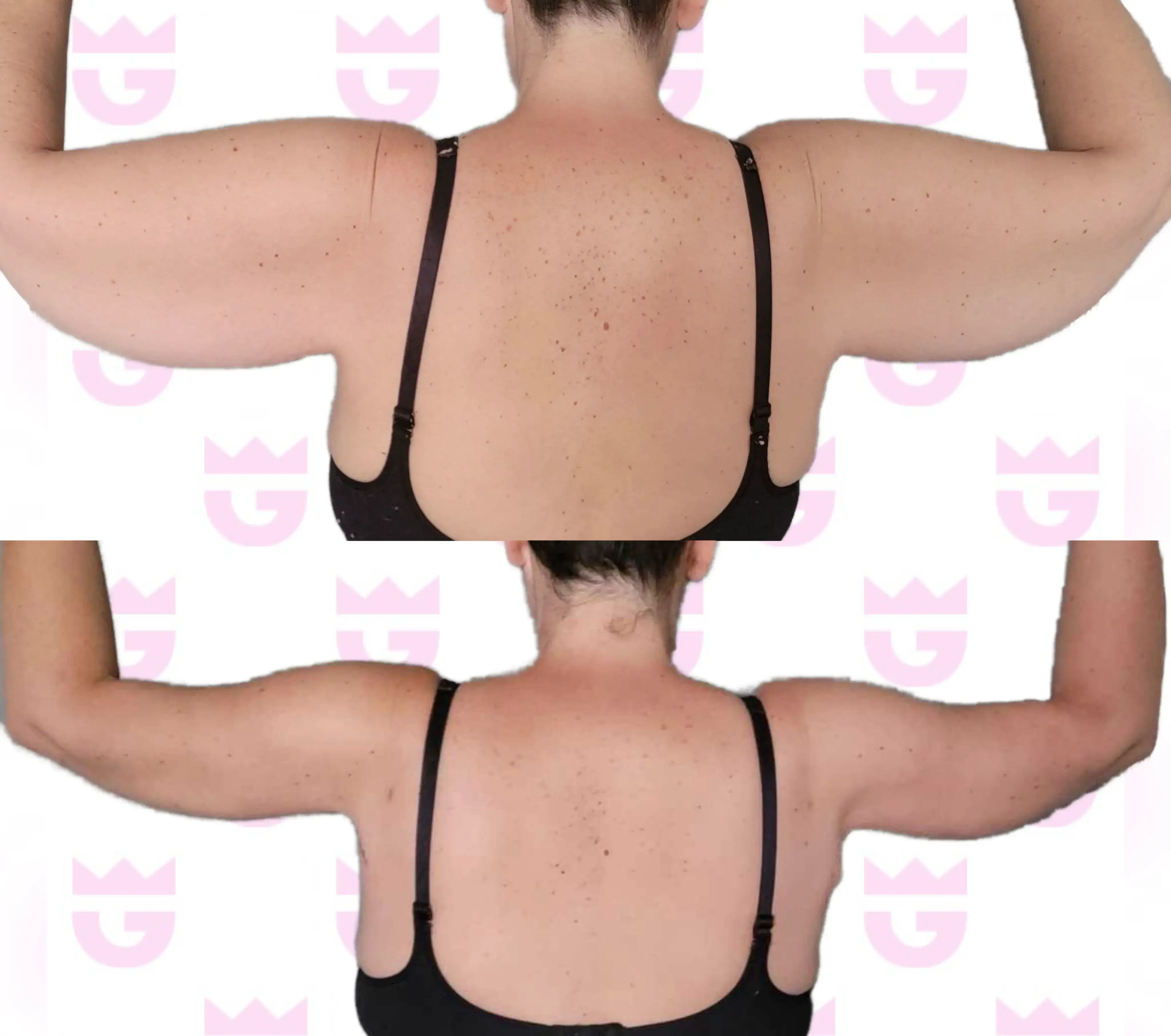 Arm Lift Gallery