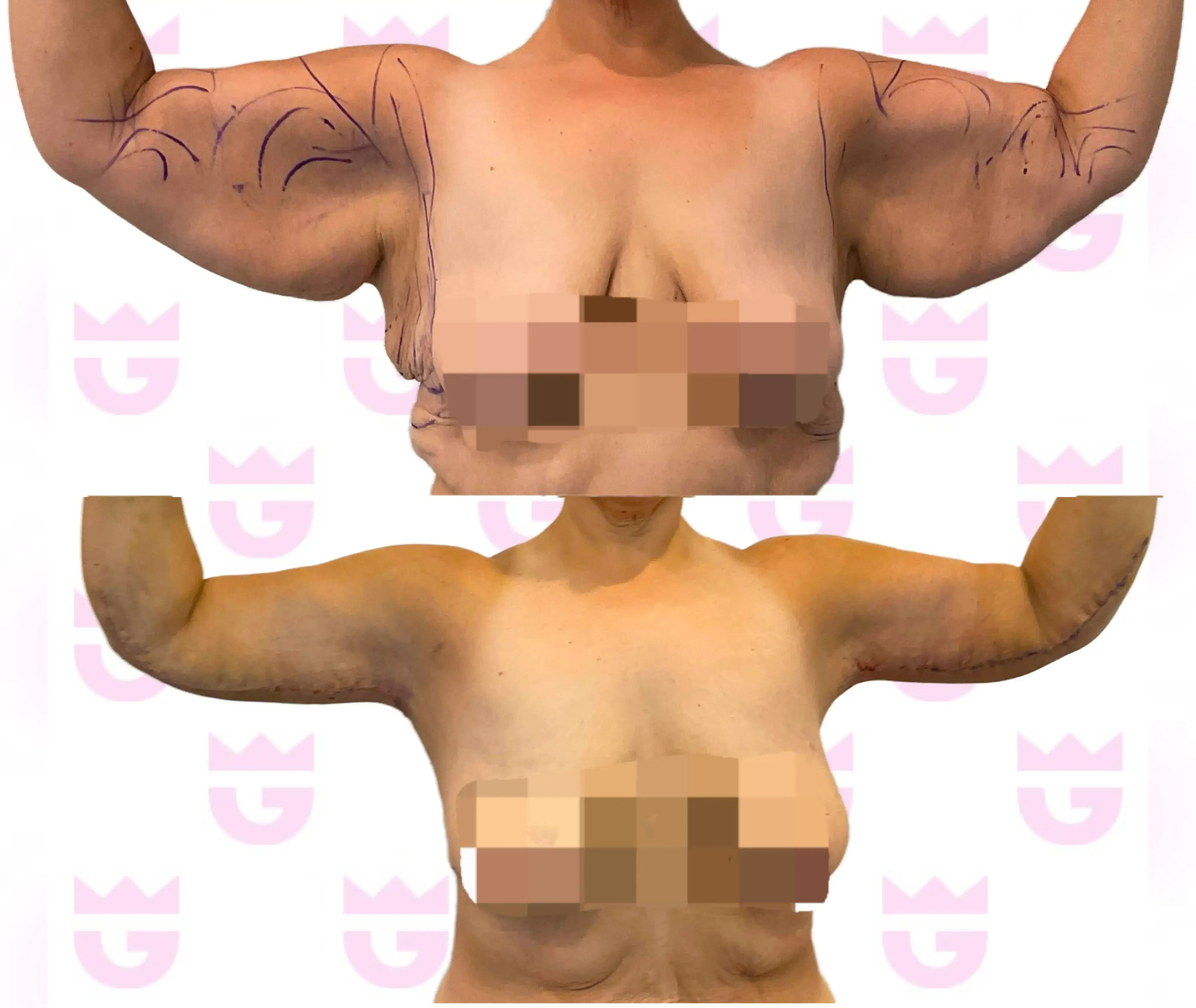 Arm Lift Gallery