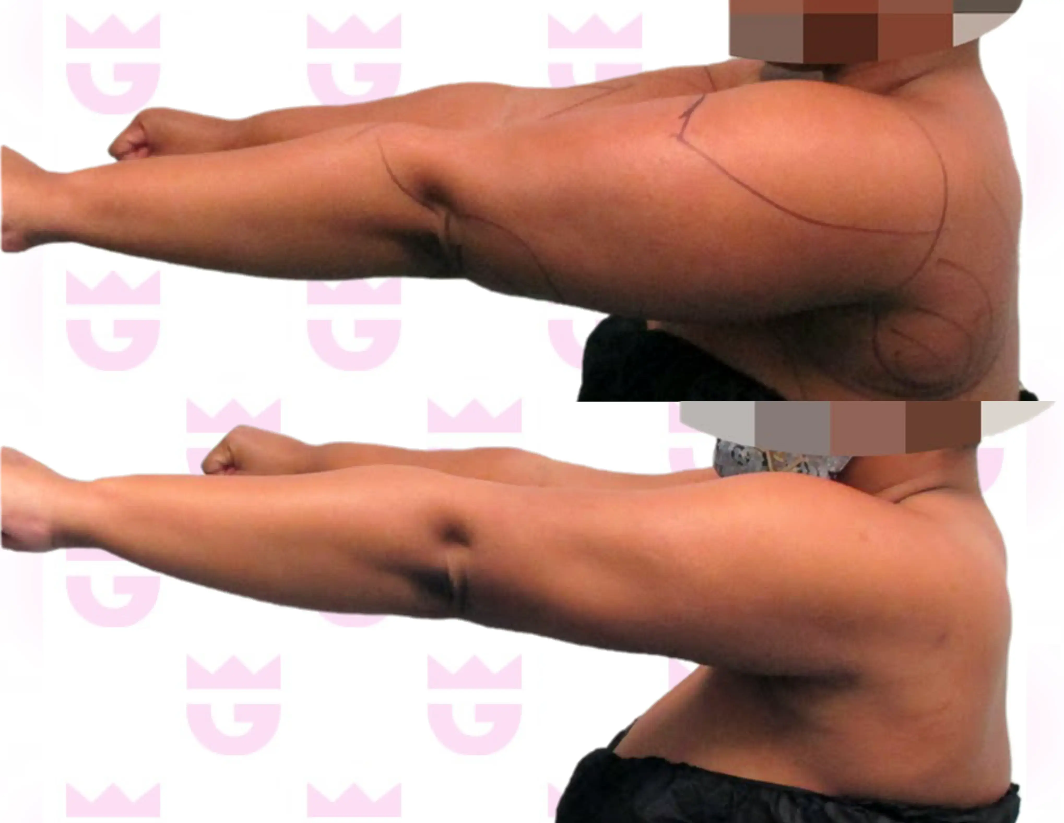 Arm Liposuction Gallery