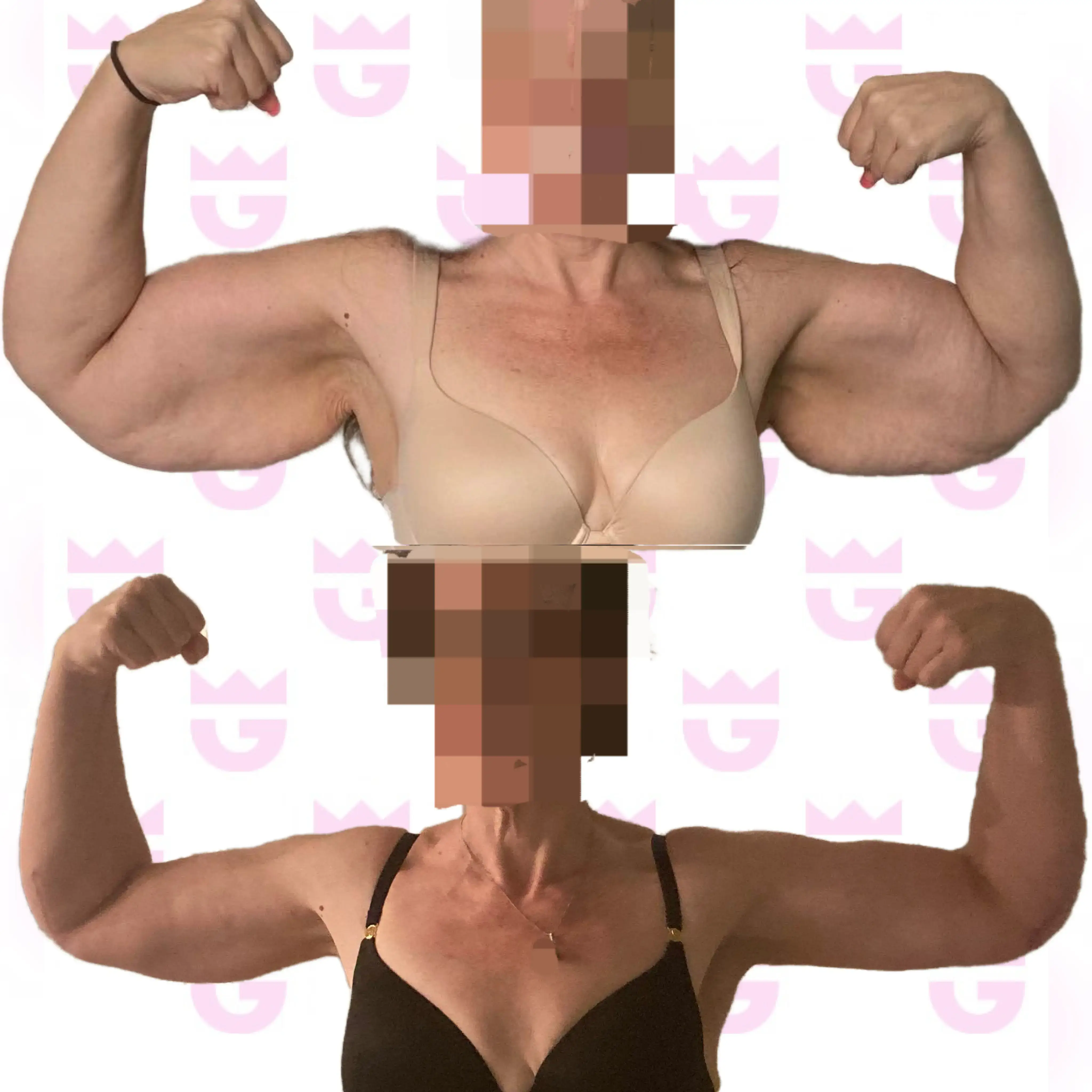 Arm Lift Gallery