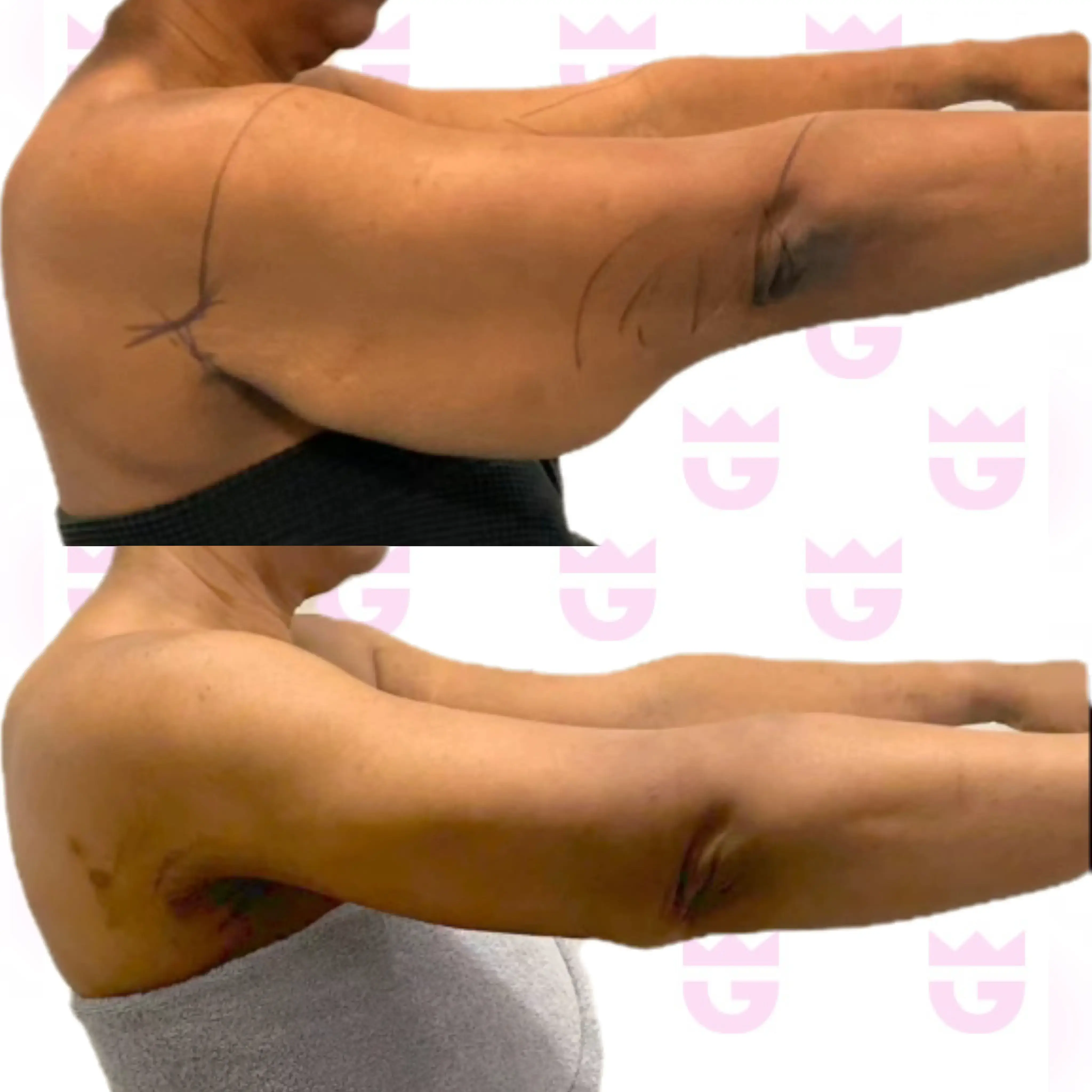 Arm Lift Gallery