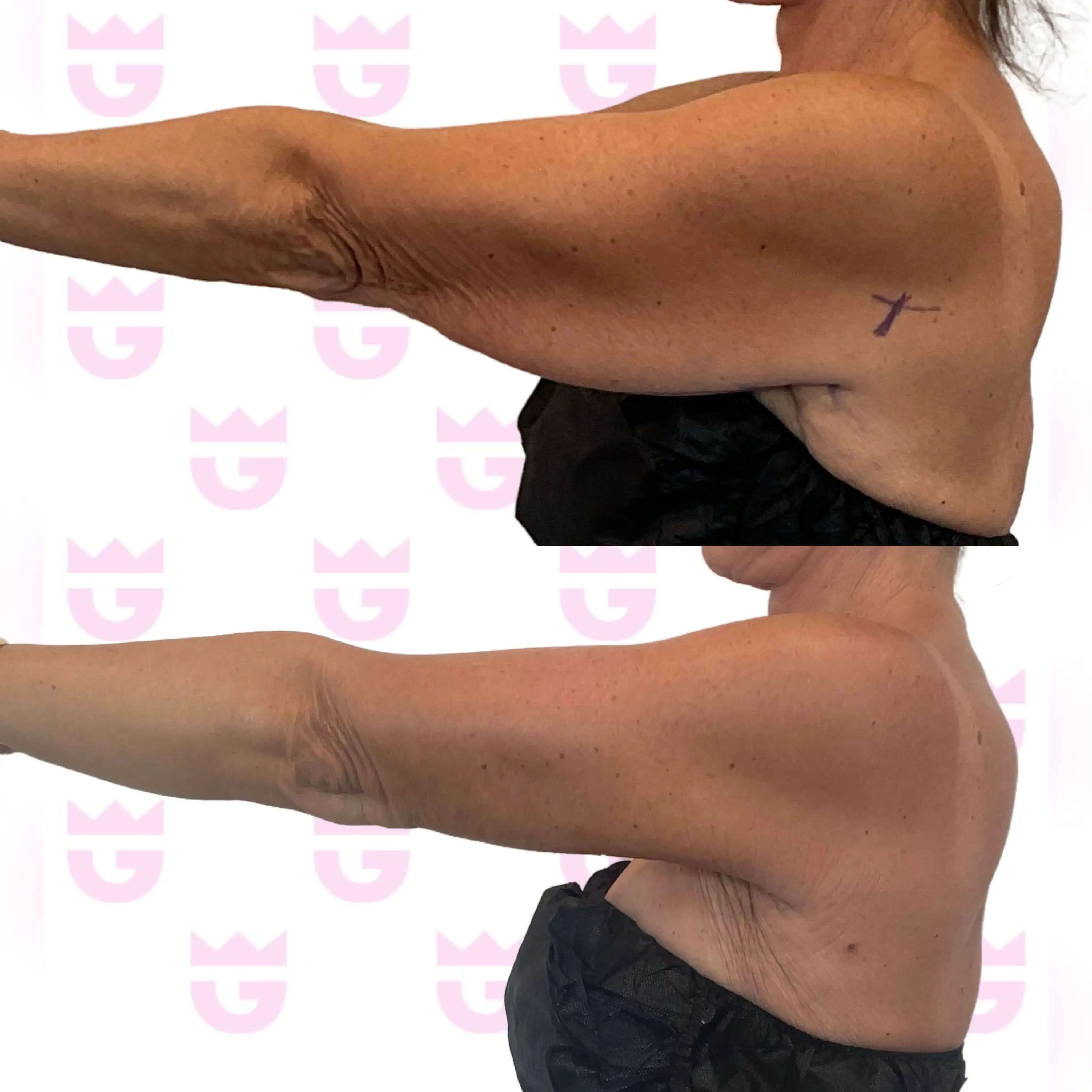 Arm Lift Gallery