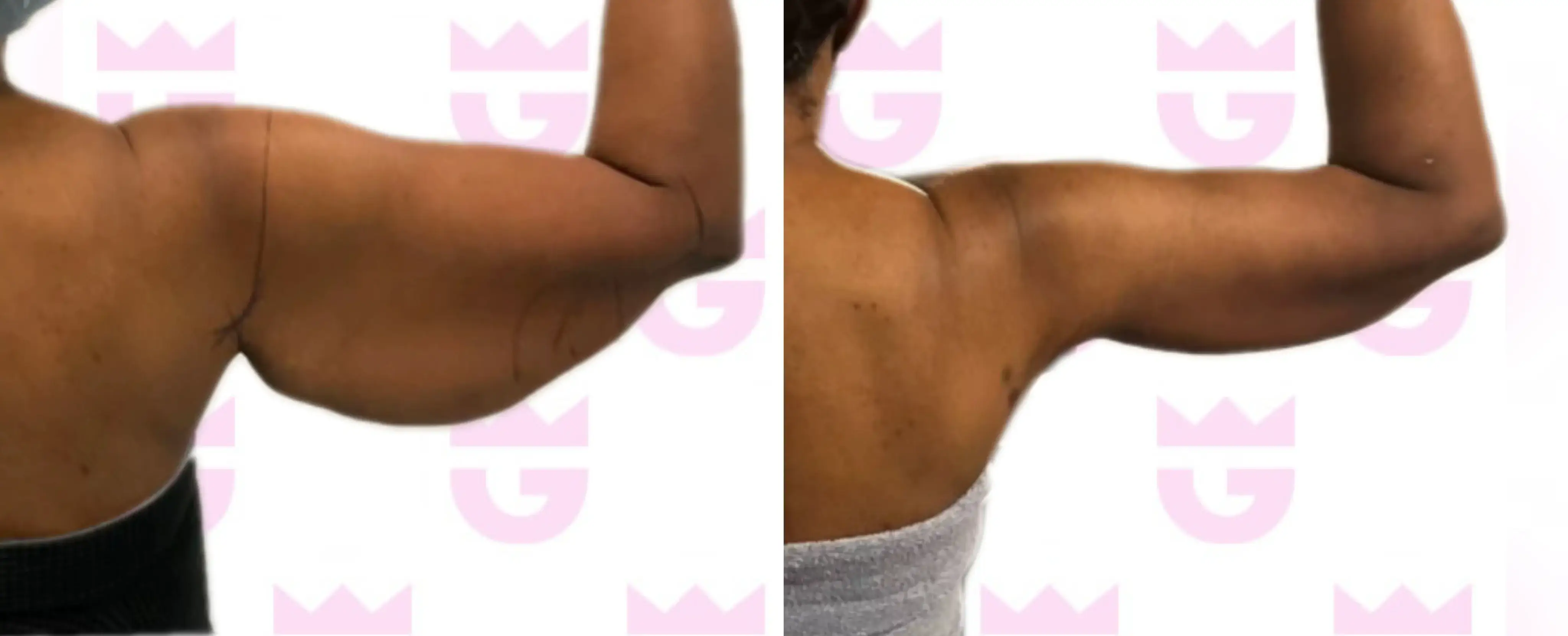 Arm Lift Gallery