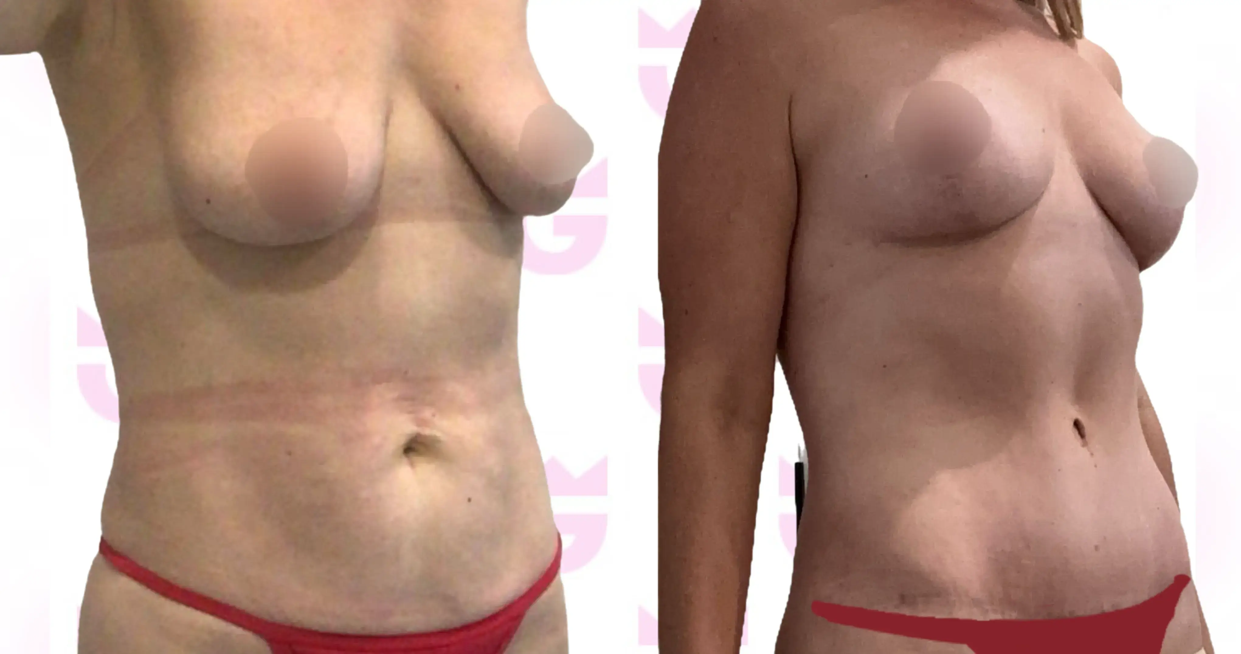 Breast Lift Gallery