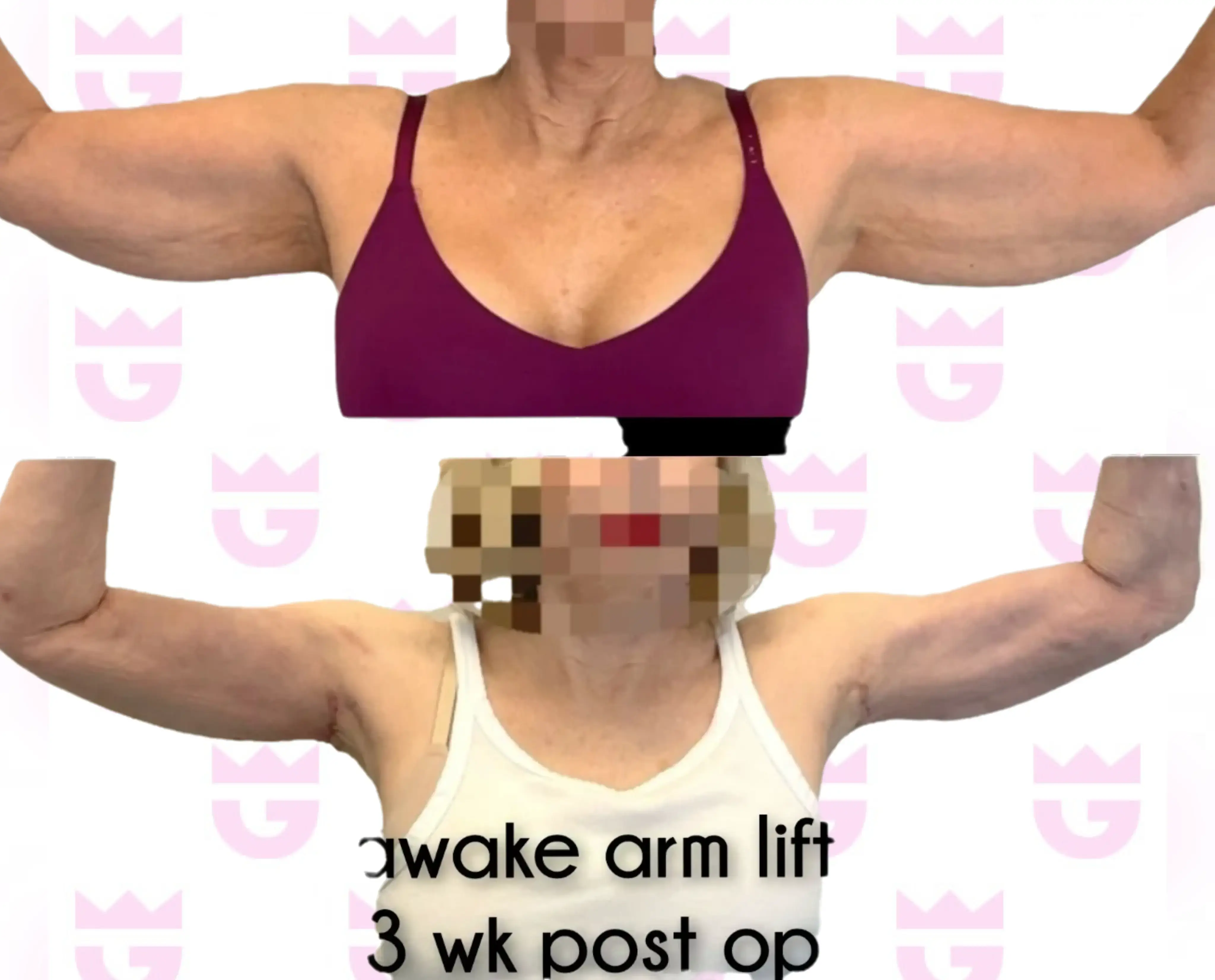 Arm Lift Gallery