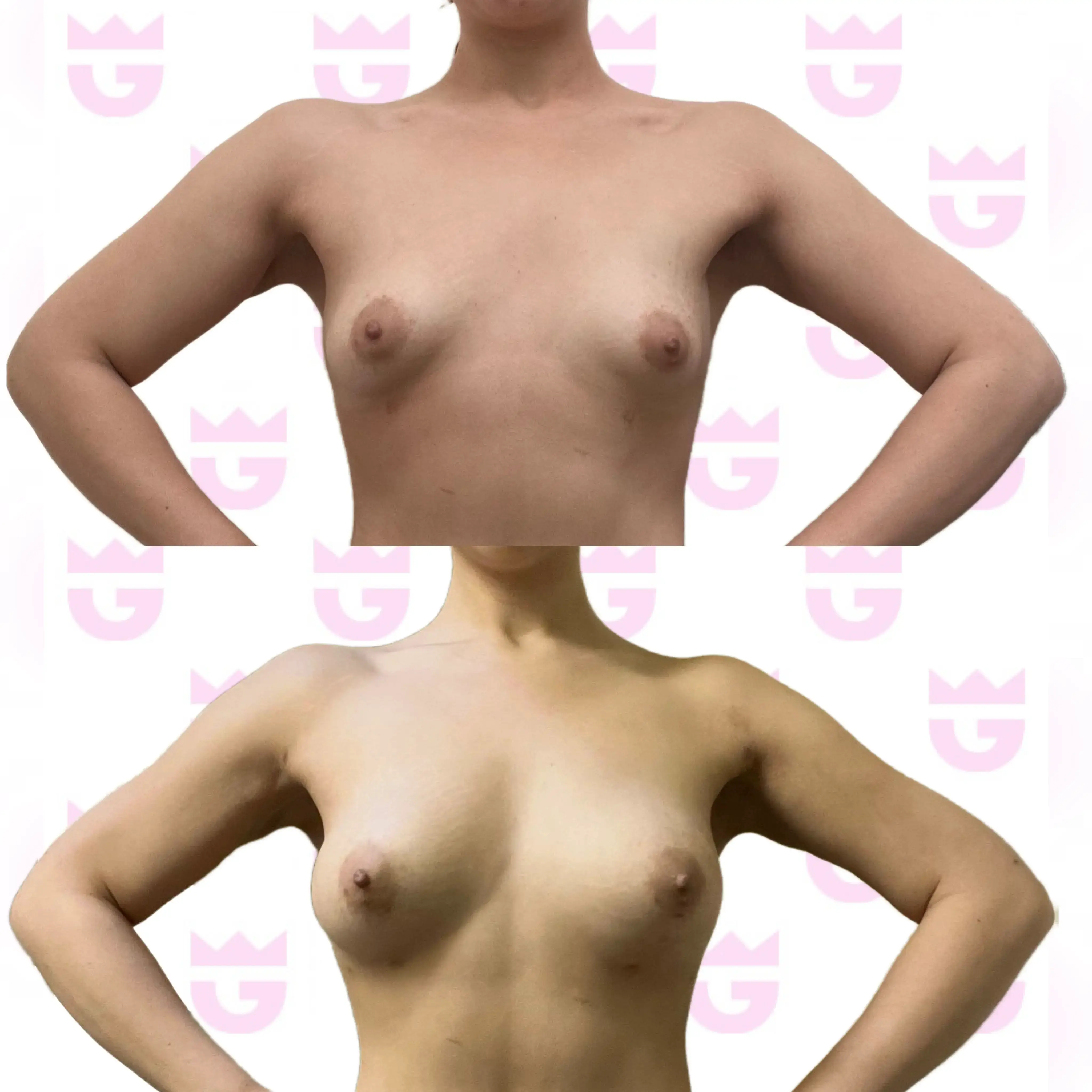 Breast Fat Transfer Gallery