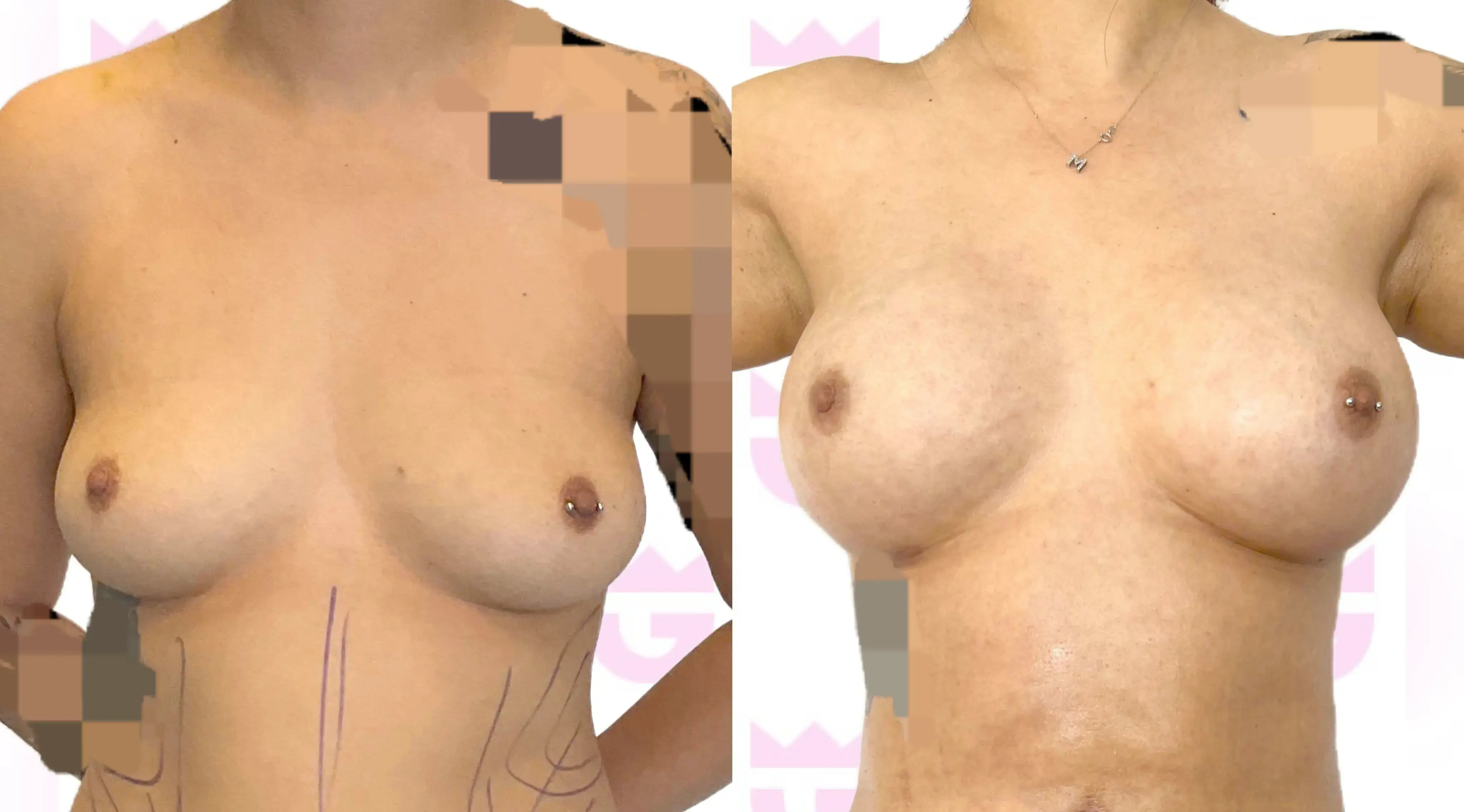 Breast Fat Transfer Gallery