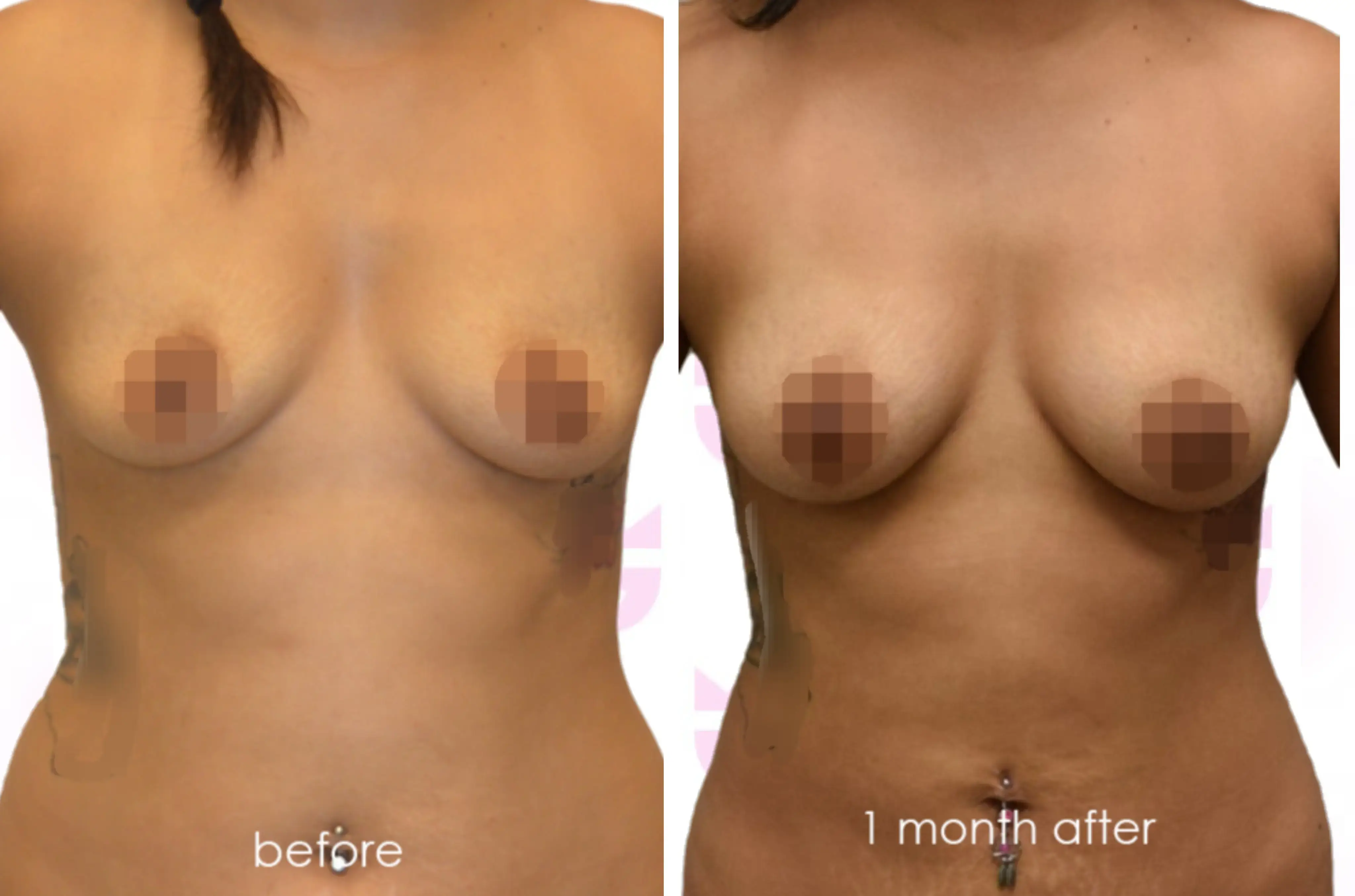 Breast Fat Transfer Gallery