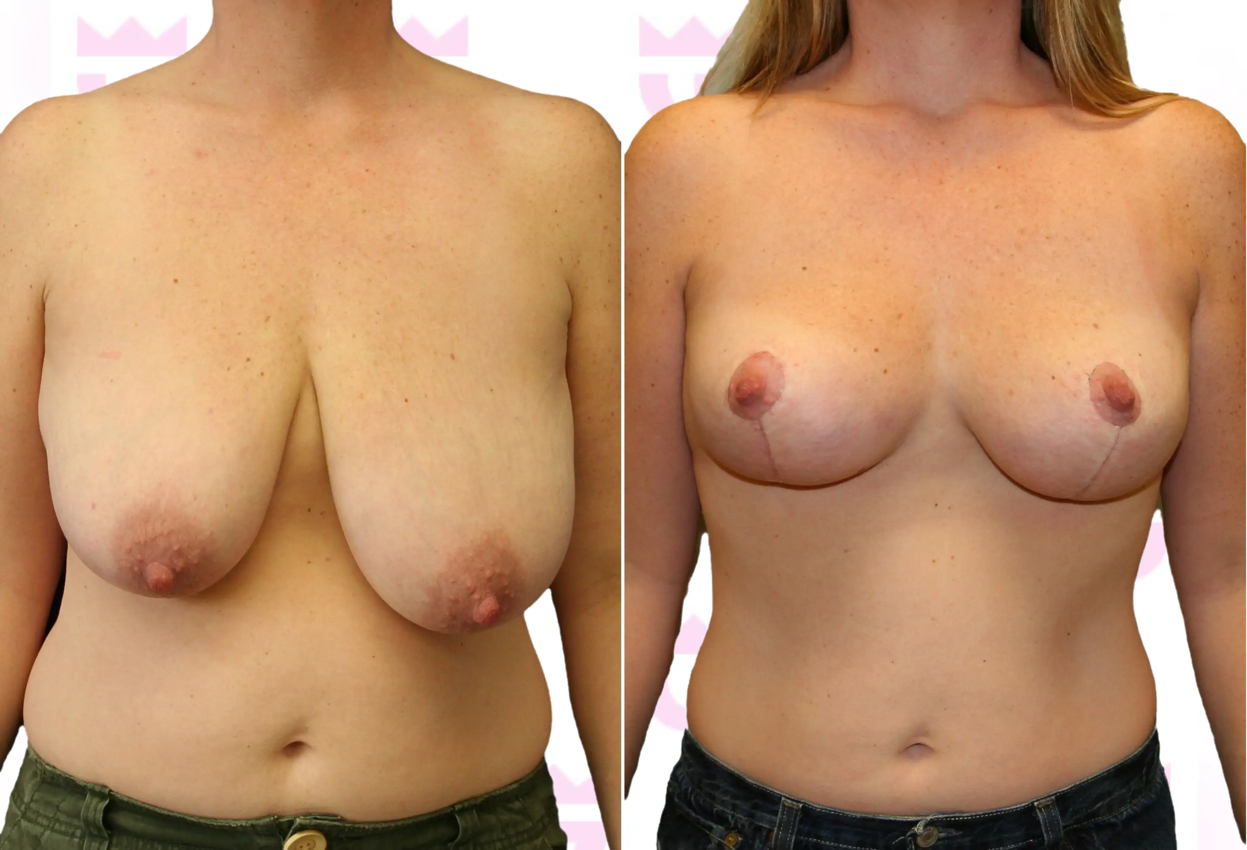 Breast Lift Gallery
