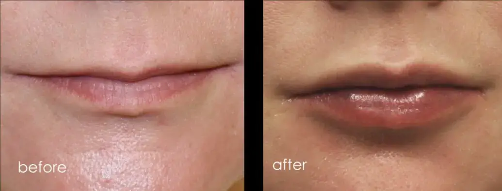 Injectables Gallery
