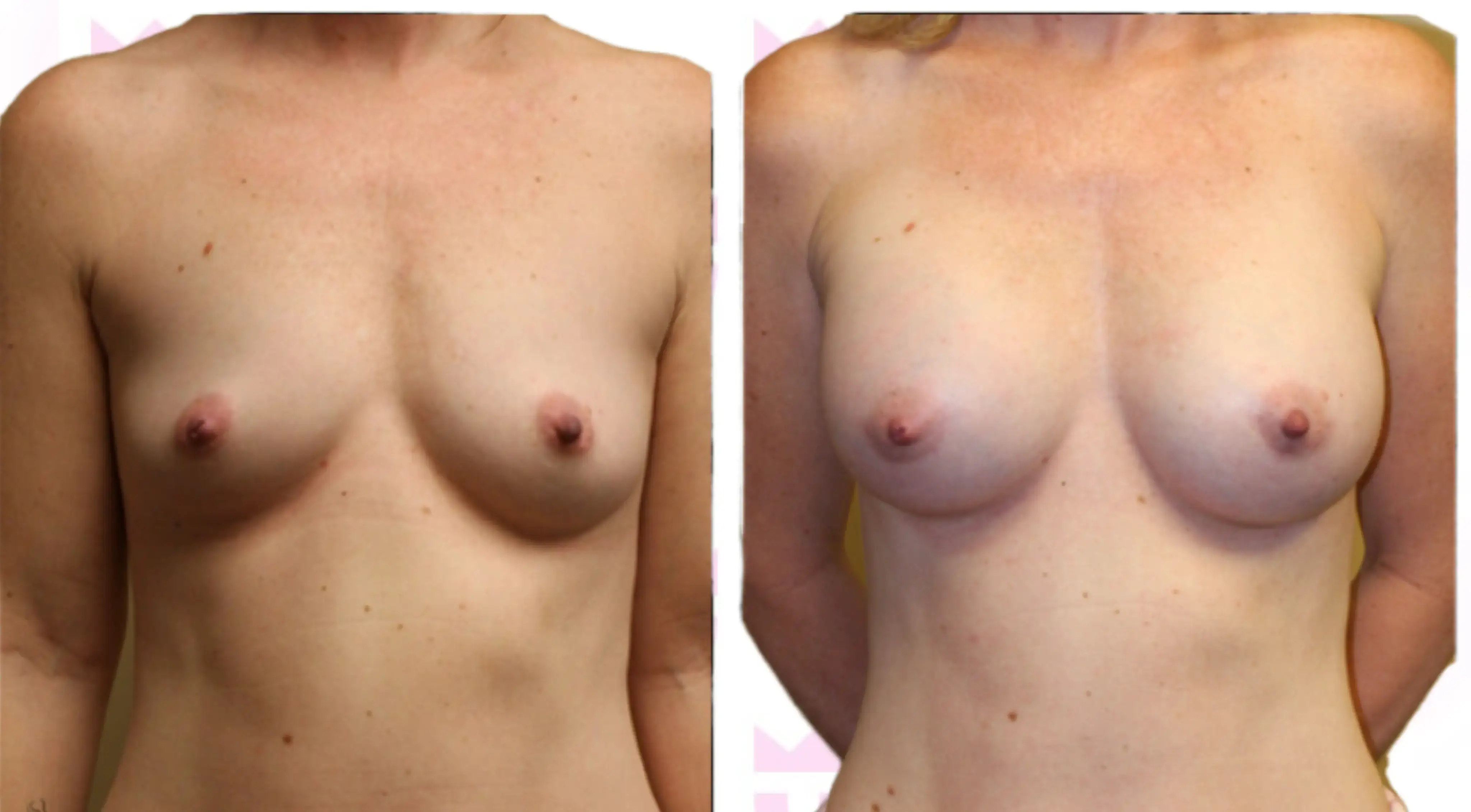 Breast Augmentation Gallery