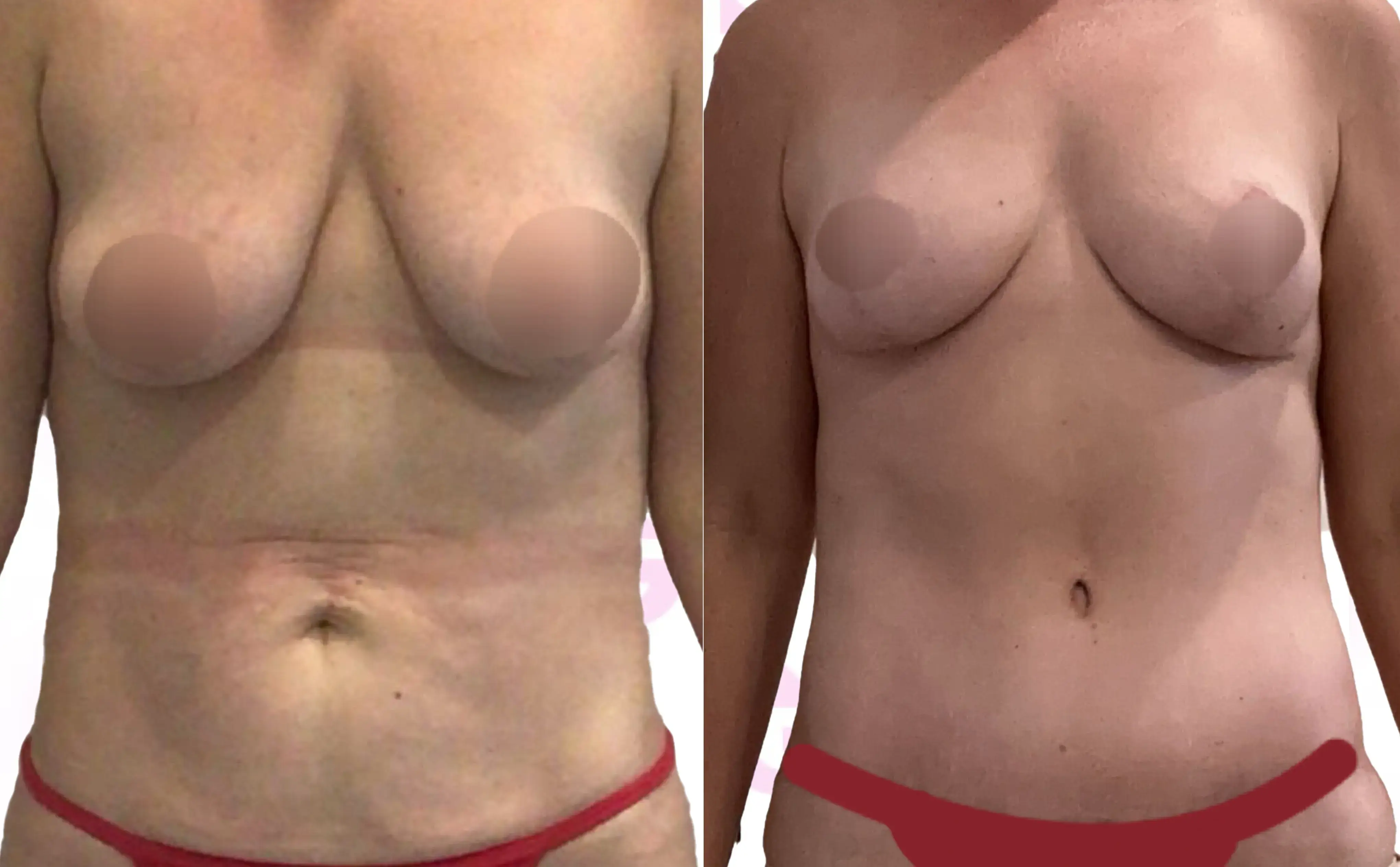 Breast Lift Gallery