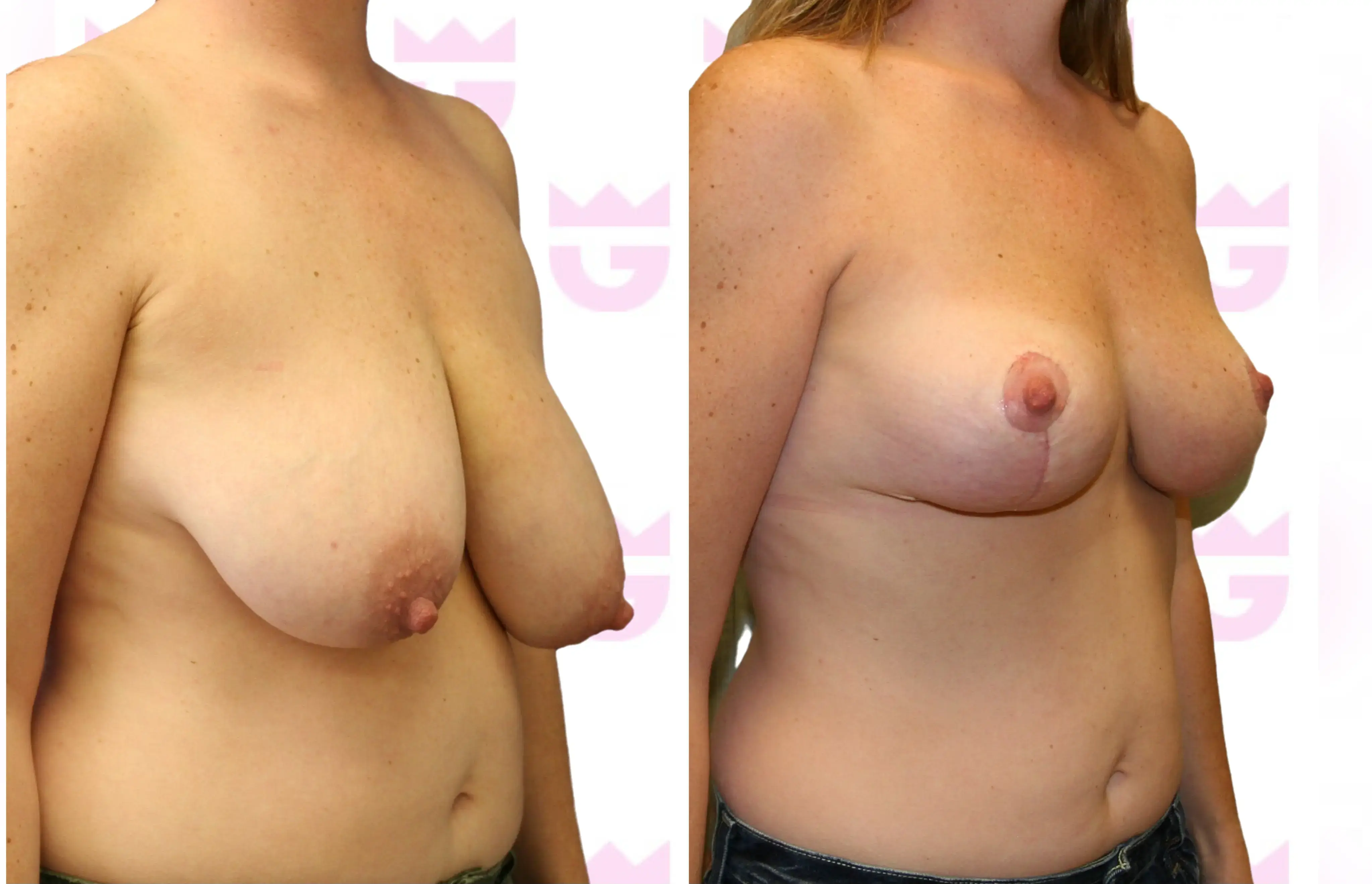 Breast Lift Gallery