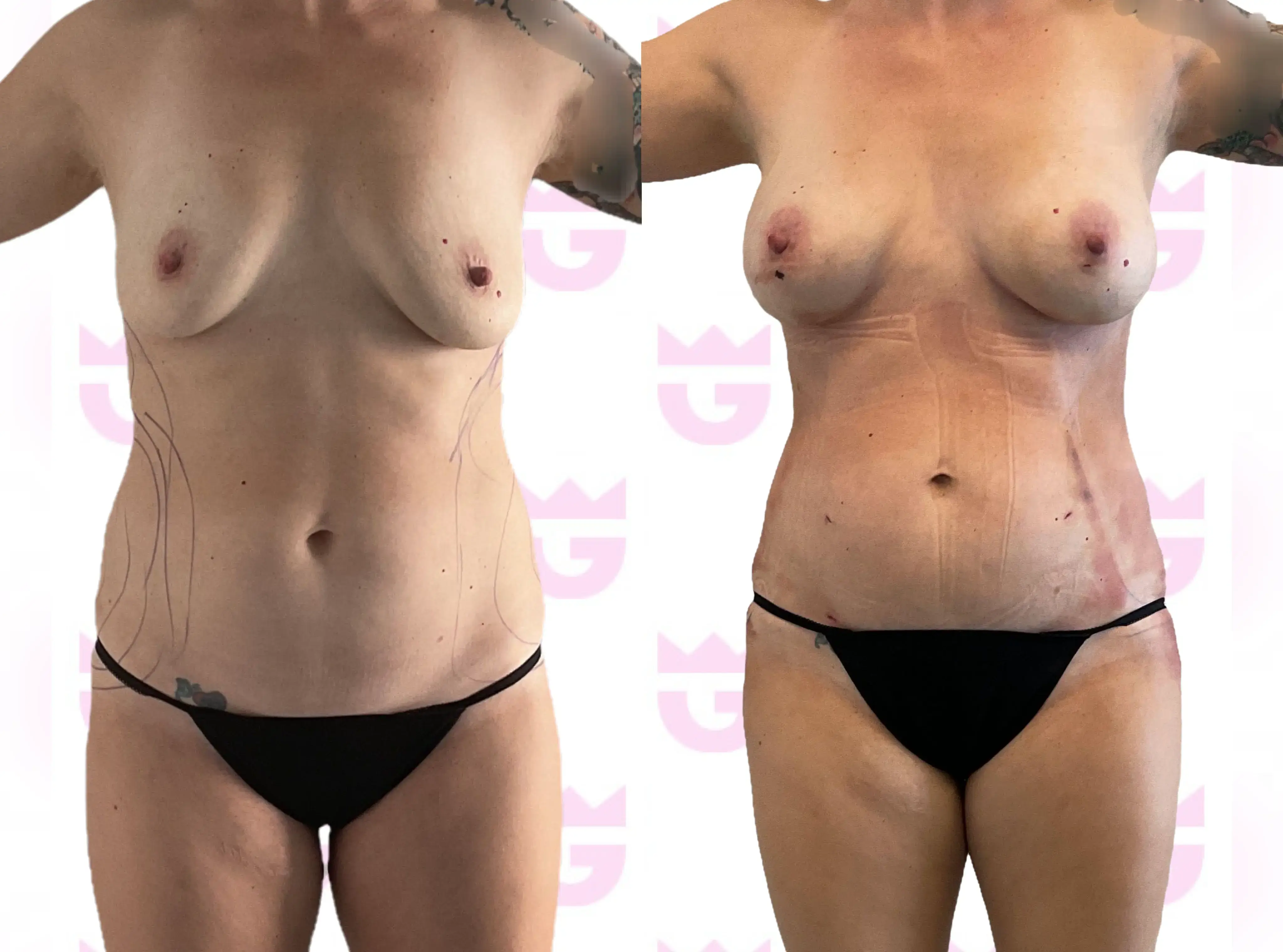 Breast Fat Transfer Gallery