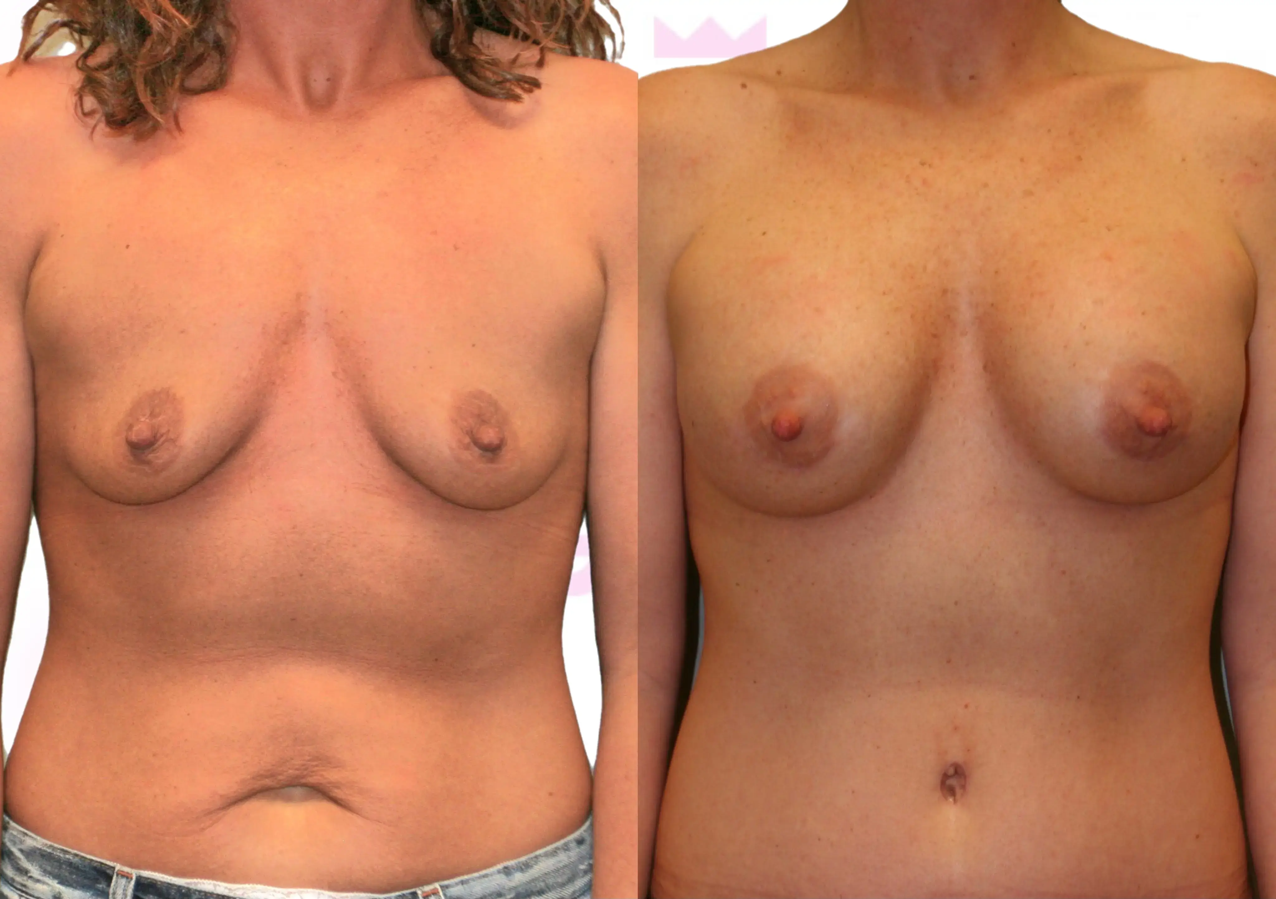 Breast Augmentation Gallery