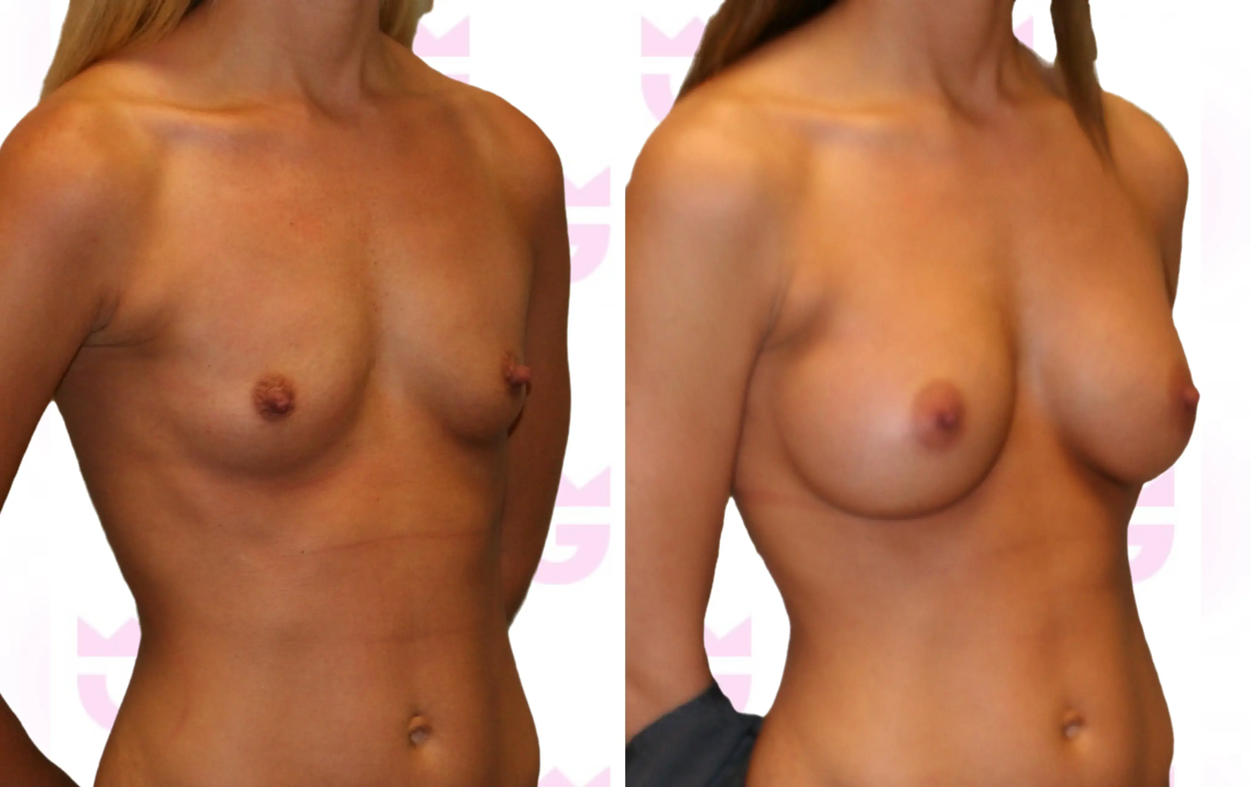 Breast Augmentation Gallery