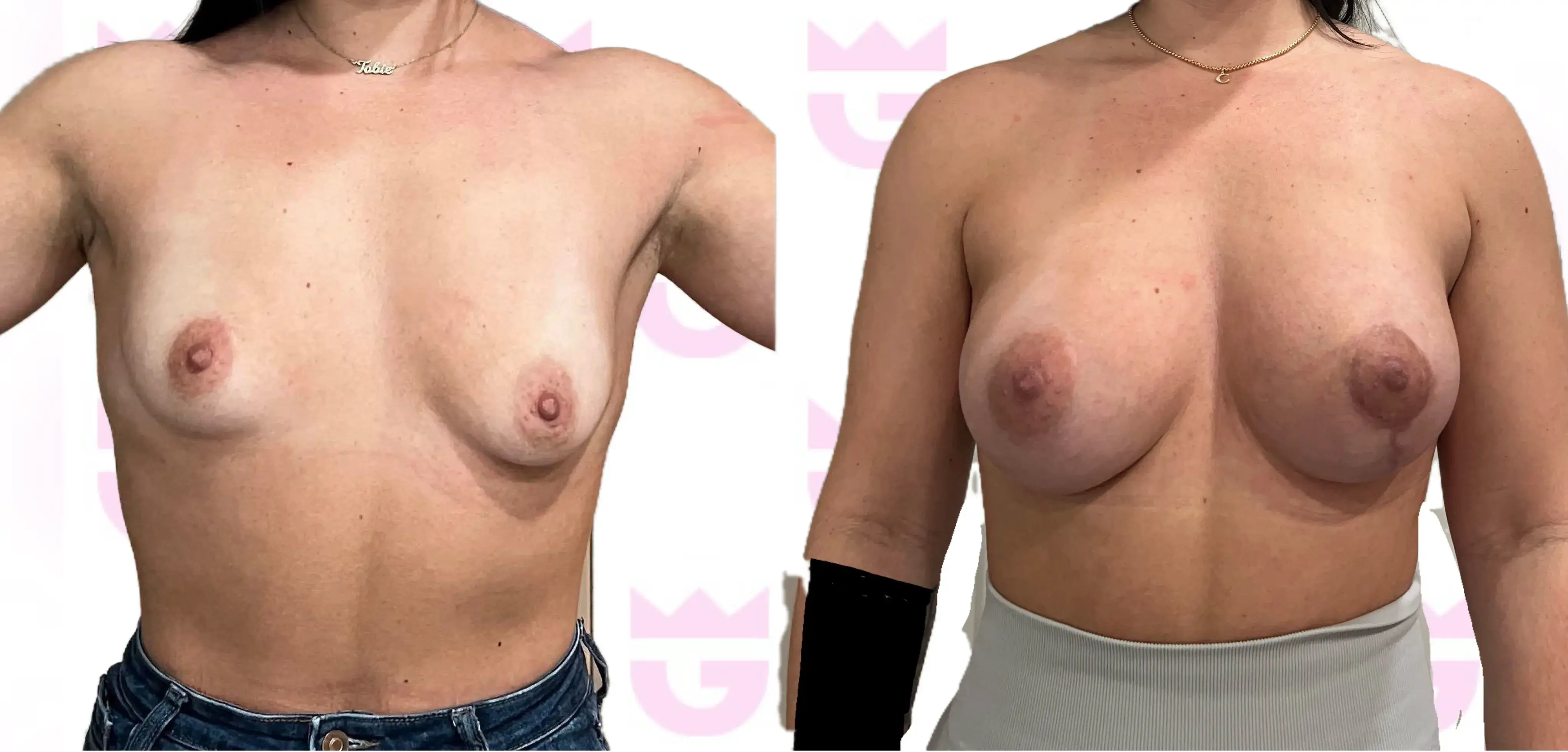 Breast Lift Gallery