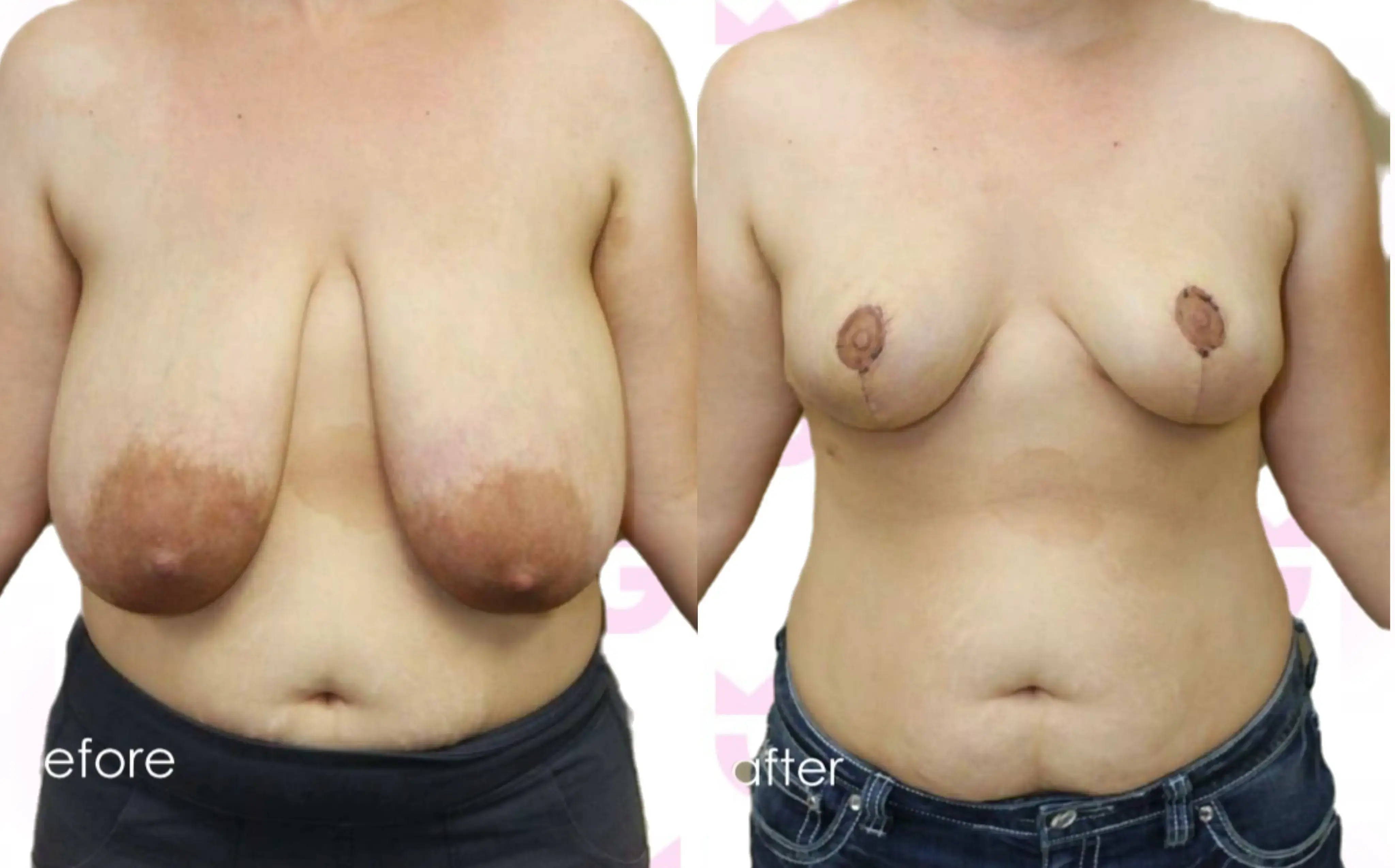 Breast Reduction Gallery