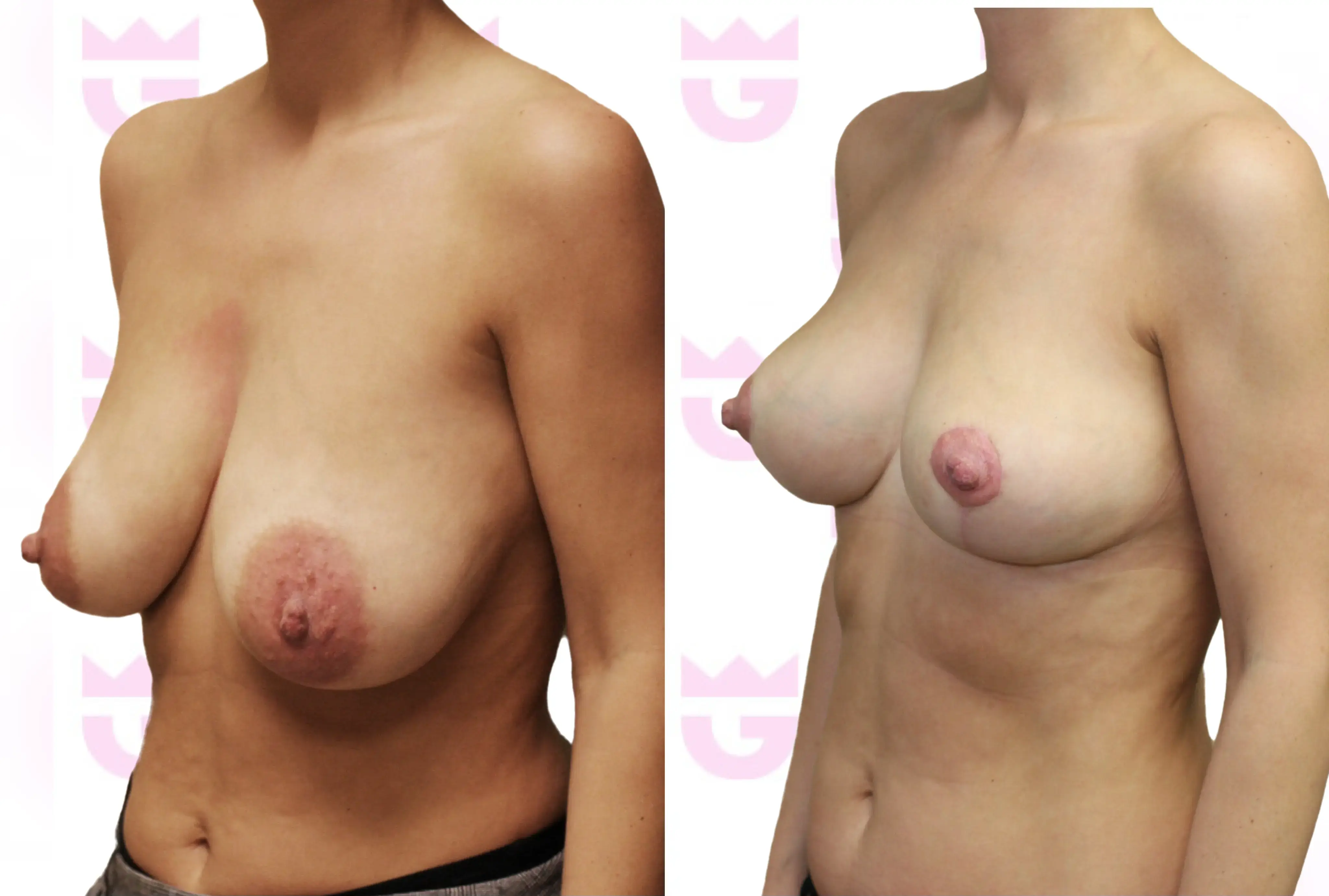 Breast Lift Gallery