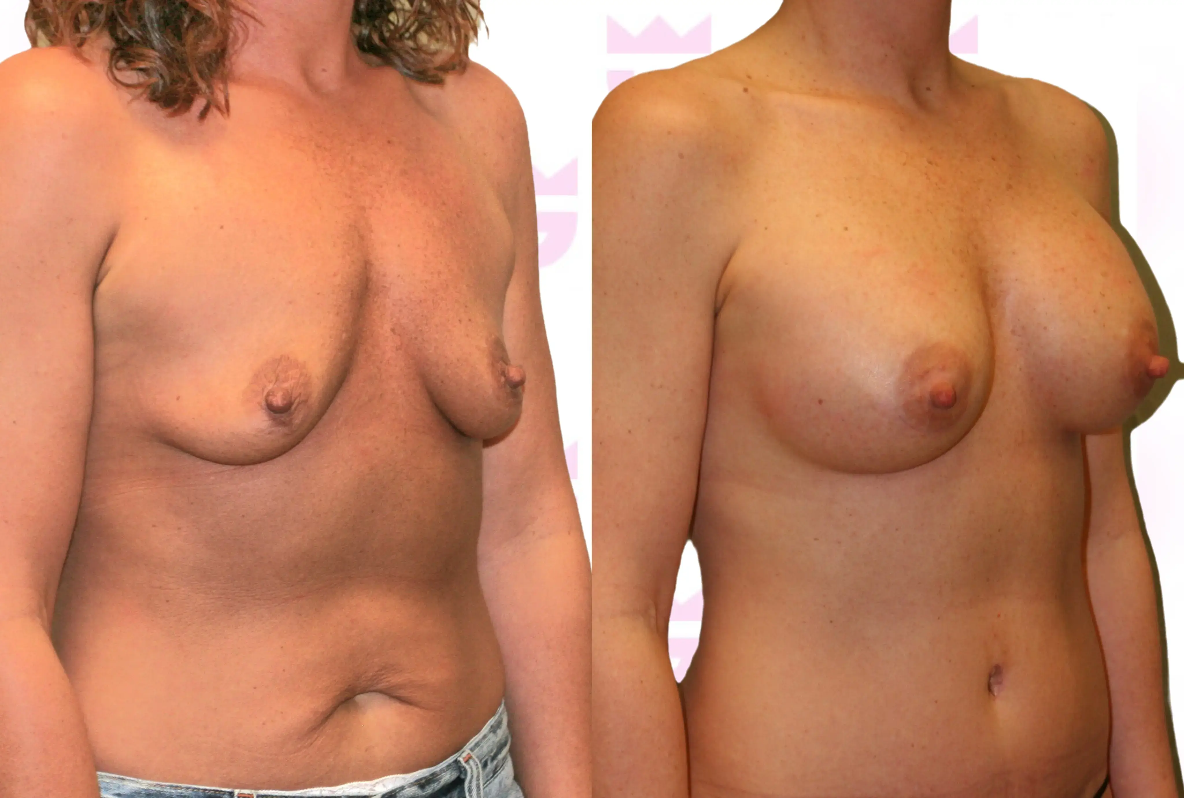 Breast Augmentation Gallery