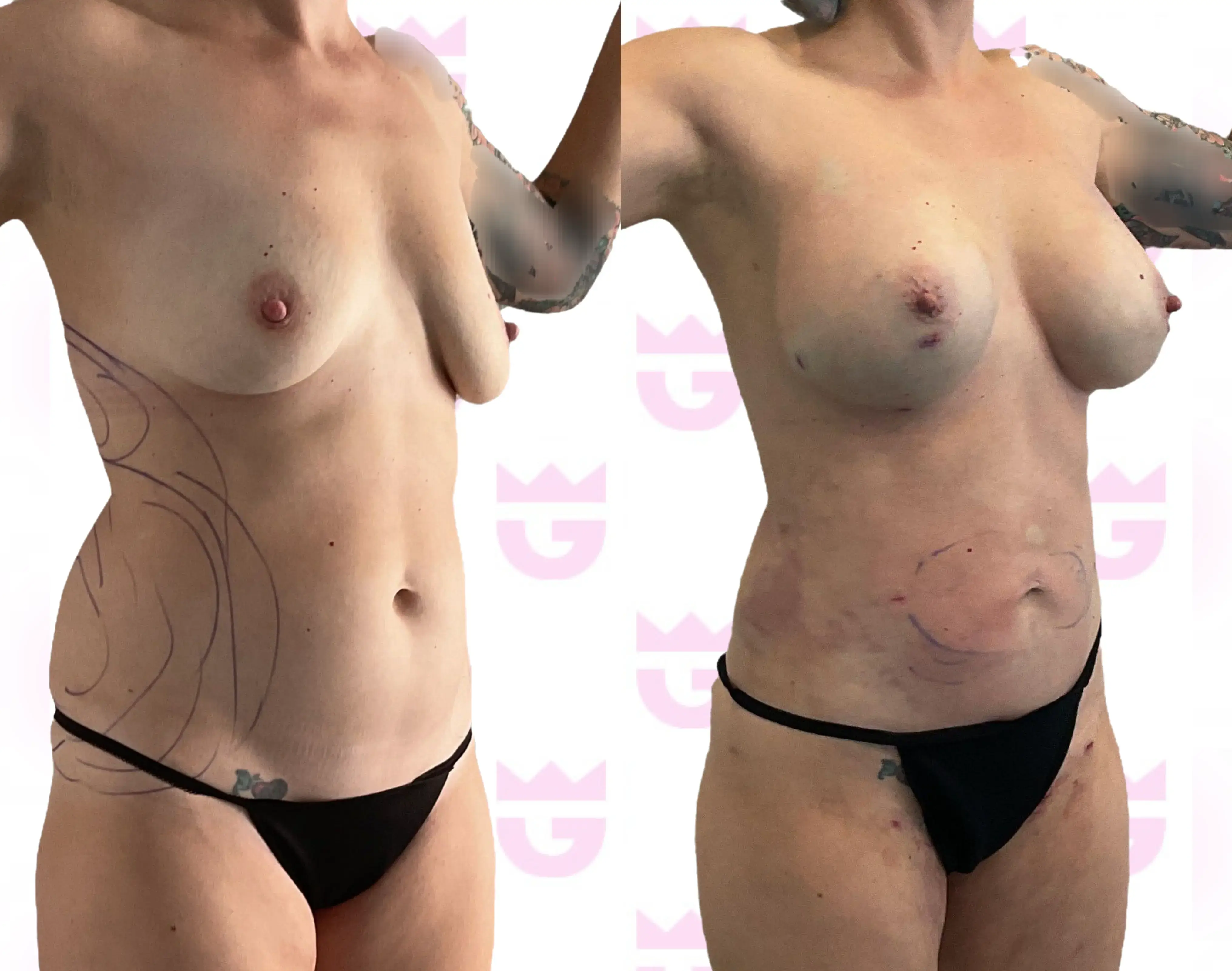 Breast Fat Transfer Gallery
