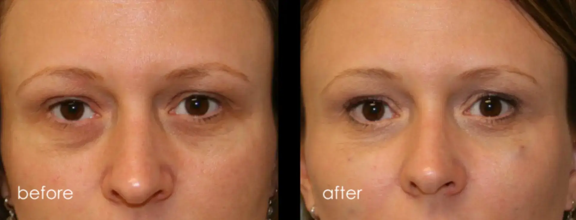 Injectables Gallery