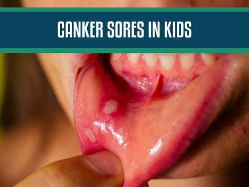 Canker Sores in Kids: Causes, Symptoms, and Relief