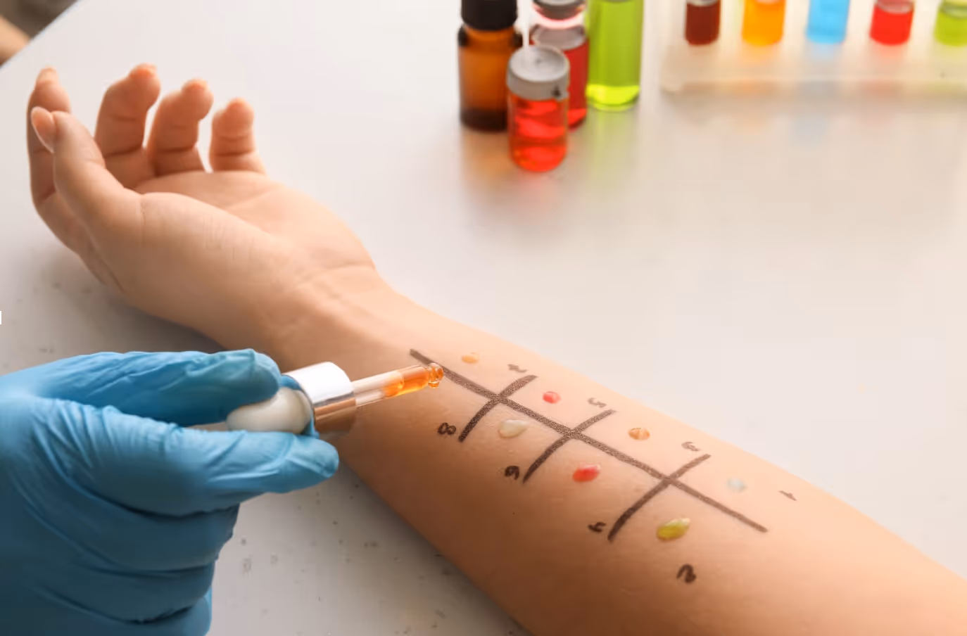 Allergy skin prick test being administered on a patient's forearm
