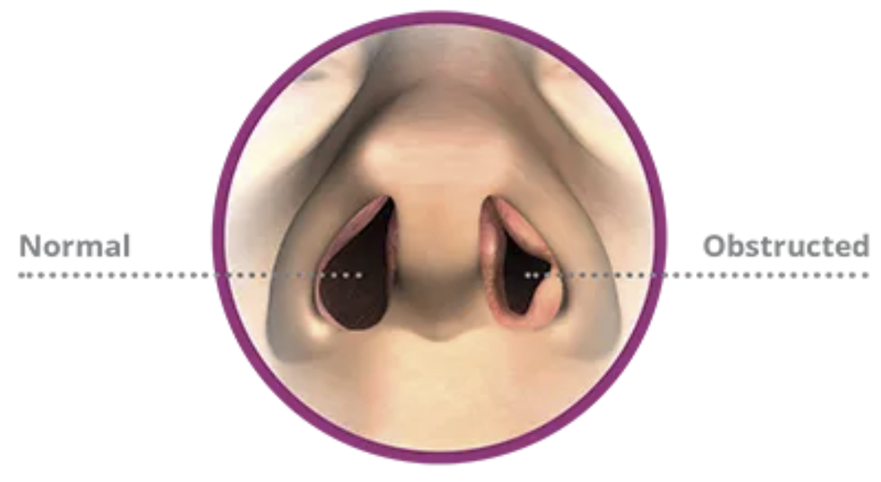 Medical illustration: the difference between nasal obstruction and an open nostril