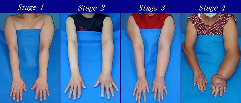 Lymphedema Grades & Stages in arms