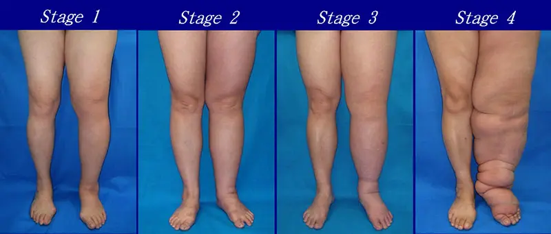 Lymphedema Grades & Stages in legs