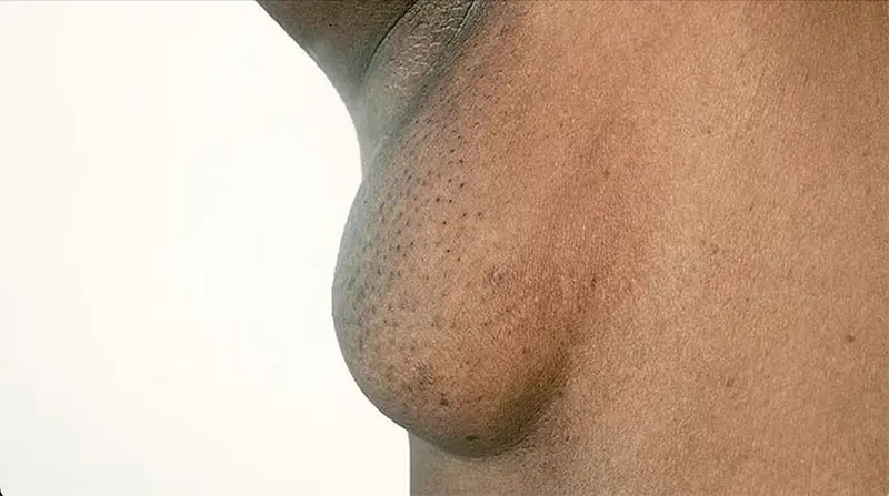 Axillary Breast Tissue in Women