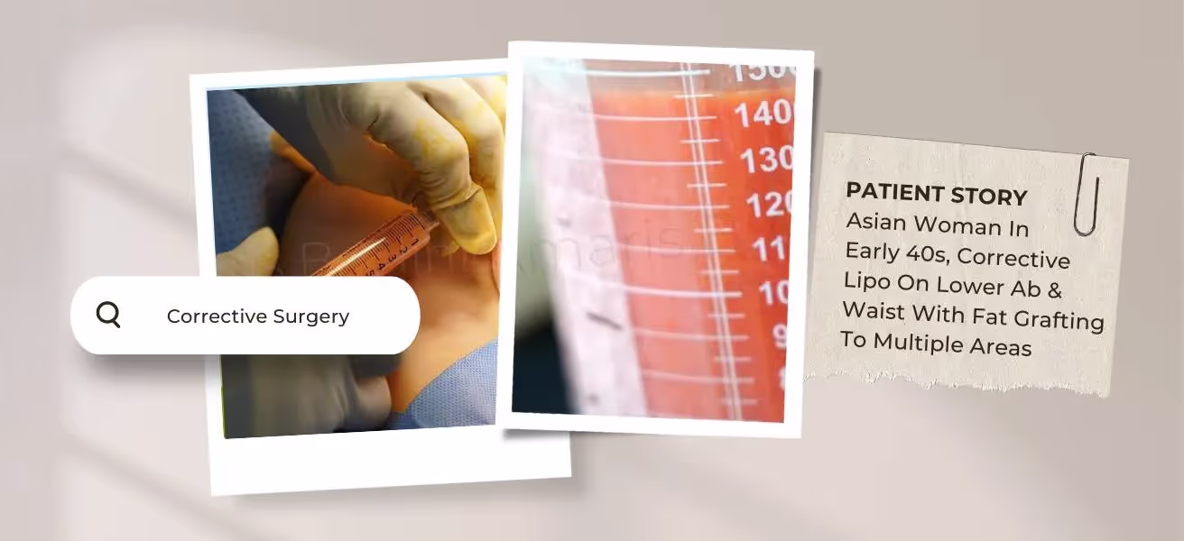 四十余岁亚洲女性腰腹部抽脂修复术联合脂肪移植