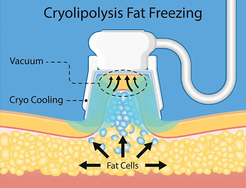 Fixing Male Chest Fat with Fat Freeze (Cryolipolysis): Is It a Bad Idea?