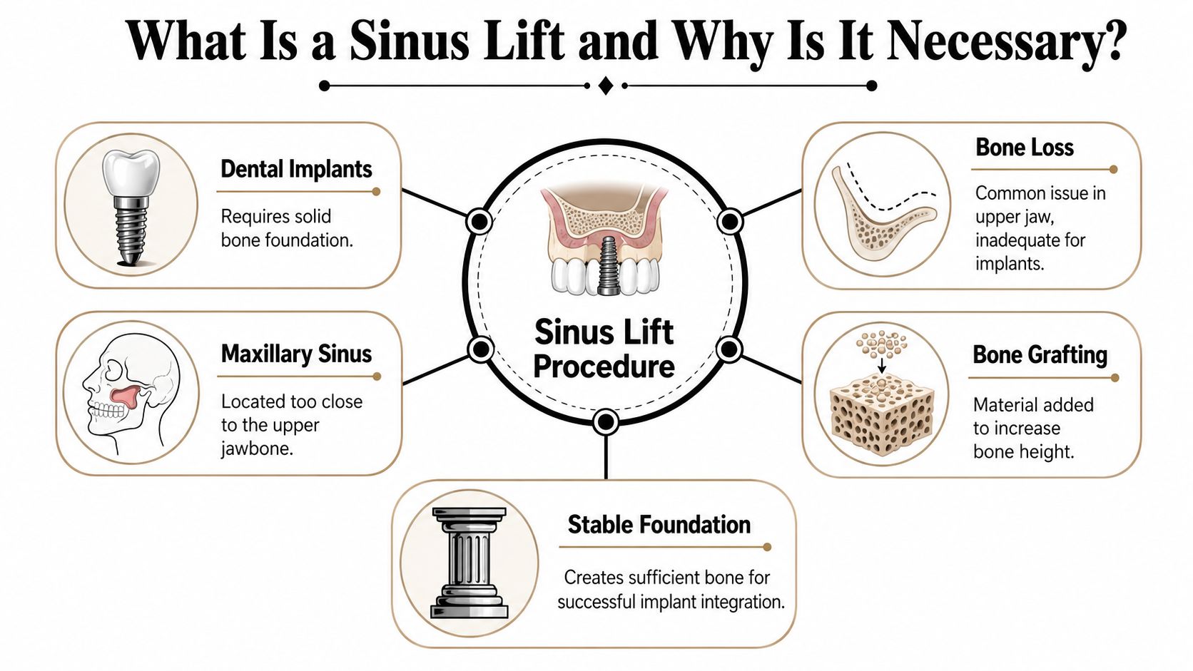 An infographic explaining the sinus lift procedure, showing how bone grafting creates a stable foundation for dental implants.